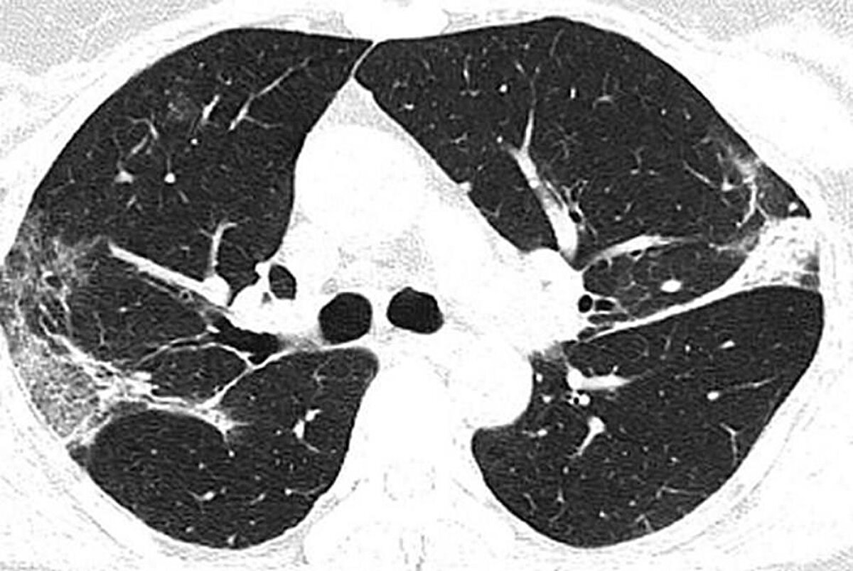 Japonya'dan döndükten sonra corona virüse yakalan Çin'in Sichuan eyaletinden 45 yaşındaki bir kadının taramalarında ise, corona virüsün akciğerinin sol üst lobunda ters hale edilmiş hale işareti oluşturdu.