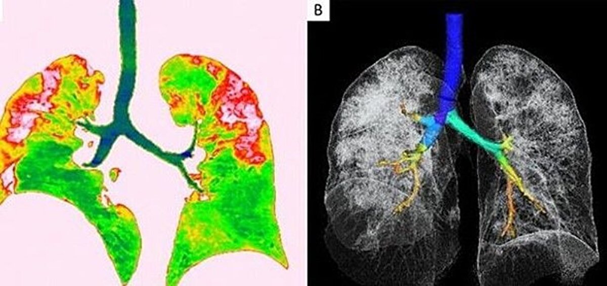 Wuhan'a seyahat ettikten sonra corona virüse yakalanan 54 yaşında bir kadının bilgisayarlı tomografi taramaları da akciğerlerinde hava boşluklarının kısmen dolduğunu gösteriyor.
Solda yer alan fotoğrafta kırmızı olarak görülen alanlarda nodüller, sağ tarafta ise akciğer ve trakeanın üç boyutlu görüntüsü yer alıyor. Beyaz alanlarda corona virüsün tahribi görülüyor.