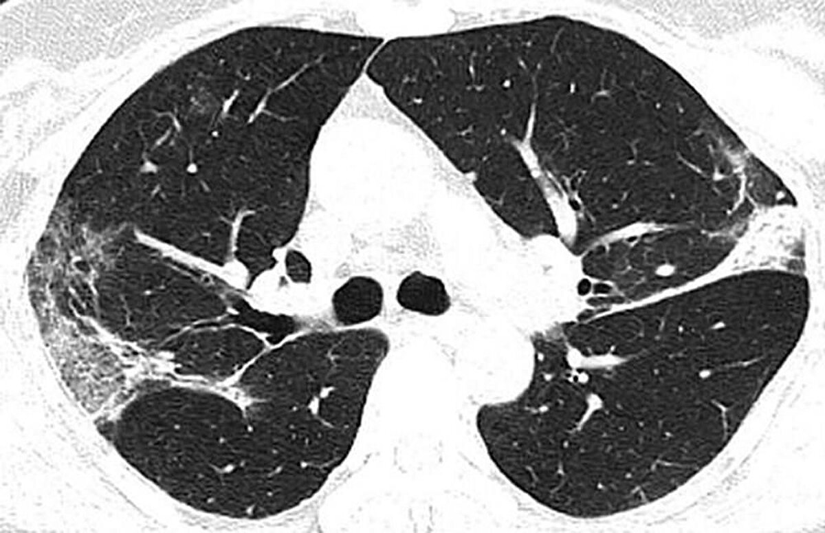 Kuzey Amerika Radyoloji Derneği (RSNA), yeni tip corona virüsün (Covid-19) ortaya çıktığı Çin’in Wuhan kentindeki salgının kaynağı olduğu düşünülen deniz ürünleri pazarında çalışan ve 44 yaşında virüs nedeniyle hayatını kaybeden bir adamın röntgen filmlerini kamuoyuyla paylaştı. Filmlerde corona virüsün akciğerleri nasıl tahrip ettiği net bir şekilde görülüyor.