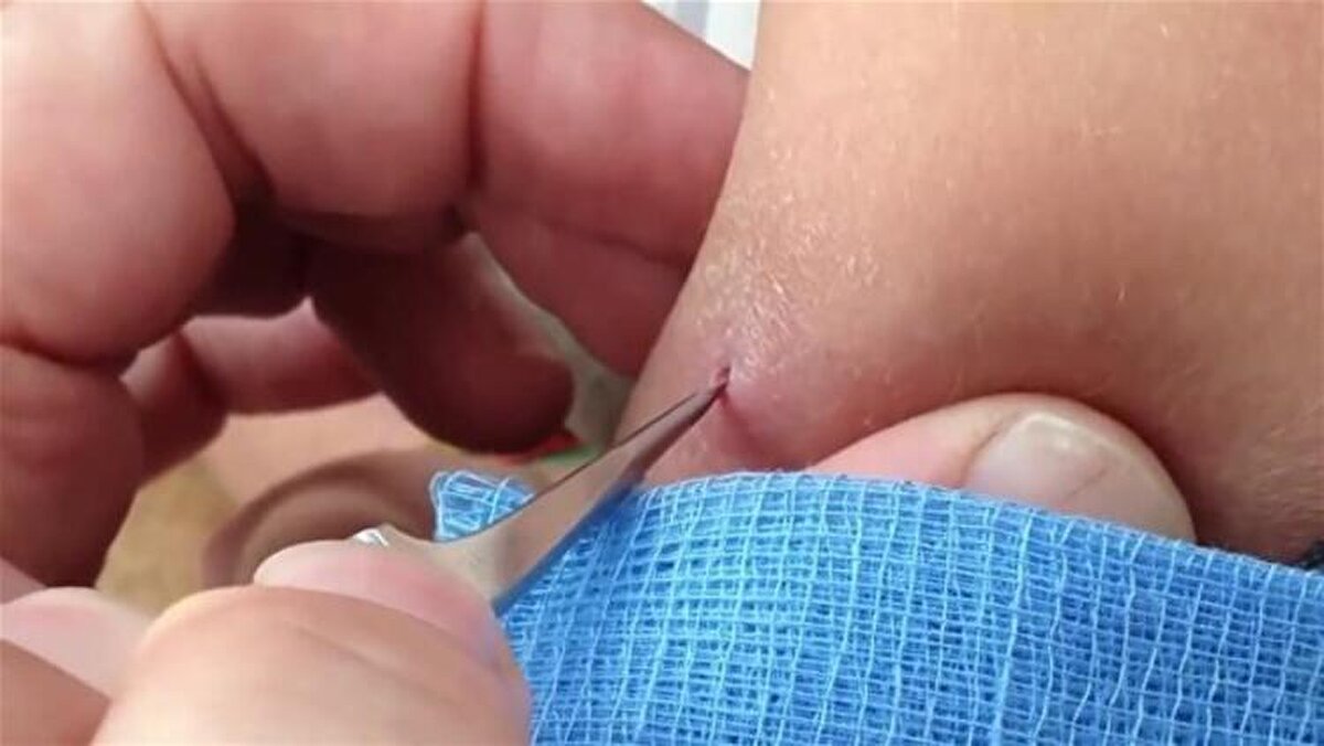 Yaranın içinden çıkan tropikal bölgede yaşayan ve larvalarını deri altına bırakan botfly cinsi sinekti.