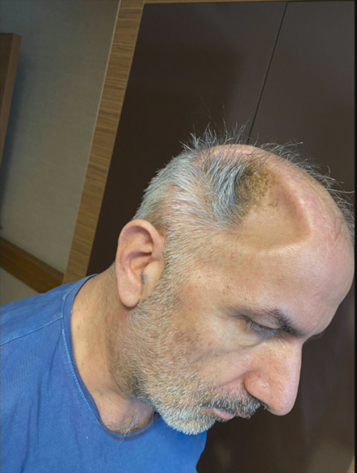 Ödemin yarattığı baskı giderilse de beyninde oluşan içe doğru çökme nedeniyle oluşan kafa içi basıncı beyin dokusuna zarar vermeye başladı. Haftalar içinde vücut fonksiyonları bozuldu, kendi başına yürüyemez hale geldi, yutkunması zayıfladı ve ilaçlarını dahi yutamaz oldu. Ondaki bu geriye gidişten endişelenerek başka bir doktor arayışına giren ailesi, bir tavsiye ile Beyin Cerrahi Uzmanı Opr. Dr. Halil Olgün Peker'e ulaştı.