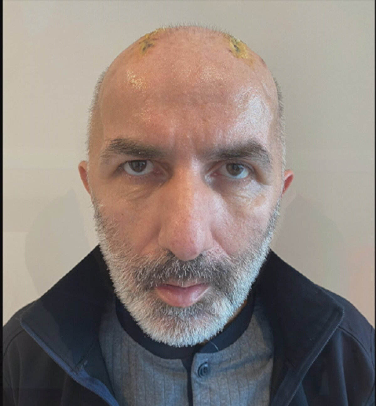 İstanbul'da bir restoranda çalışan 48 yaşındaki Osman Yılmaz'ın hayatı yaklaşık 6 ay önce geçirdiği trafik kazası ile alt üst oldu. Yaya olarak yürürken araç çarpması sonucu beyin kanaması geçiren Yılmaz'a ilk müdahale yapılan hastanede, kazadan dolayı kafa içinde oluşan ödemin beyne baskı yapmasını önlemek için kafatası kemikleri geçici olarak çift taraflı çıkarıldı ve doku kaybı olmadan steril bir şekilde korunabilmesi için karnının içine yerleştirildi. İstanbul'da bir restoranda çalışan 48 yaşındaki Osman Yılmaz'ın hayatı yaklaşık 6 ay önce geçirdiği trafik kazası ile alt üst oldu. Yaya olarak yürürken araç çarpması sonucu beyin kanaması geçiren Yılmaz'a ilk müdahale yapılan hastanede, kazadan dolayı kafa içinde oluşan ödemin beyne baskı yapmasını önlemek için kafatası kemikleri geçici olarak çift taraflı çıkarıldı ve doku kaybı olmadan steril bir şekilde korunabilmesi için karnının içine yerleştirildi.