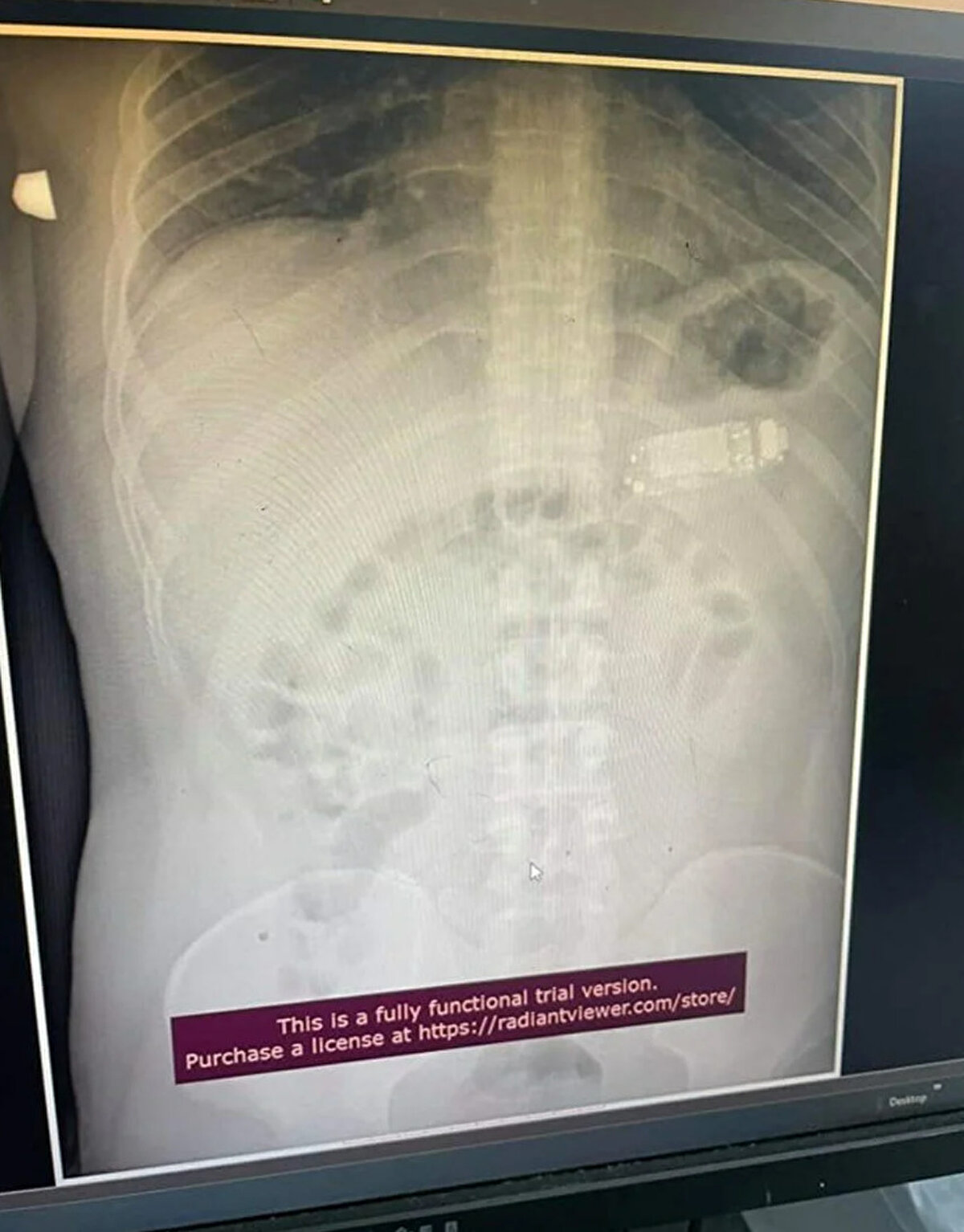 Teljaku yaptığı açıklamada, tıbbi ekibin telefonu mideyi kesmeden, endoskop olarak bilinen özel cihazlar kullanarak üç ayrı parçaya ayırmayı başardığını söyledi. Teljaku, ayrıca yaklaşık iki saat süren işlem sırasında "herhangi bir komplikasyon" yaşanmadığını sözlerine ekledi.
Bununla birlikte 33 yaşındaki adamın telefonu yuttuktan sonra yaşadığı acı nedeniyle Kosova'nın başkentindeki hastaneye gitmeye karar verdiği aktarıldı. Teljaku, özellikle bataryanın en tehlikeli parçası olduğunu, patlayarak hayatı potansiyel olarak tehlikede olan adamın bağırsaklarına kimyasal salabileceğini söyledi.