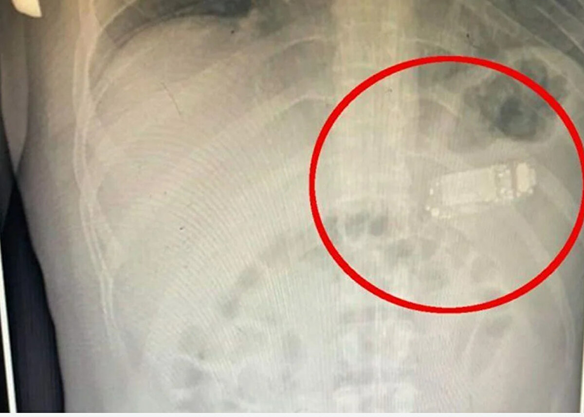 Adamın telefonu nasıl ve neden yuttuğu bilinmiyor, ancak Teljaku hastanın sağlığının iyi olduğunu söyledi.