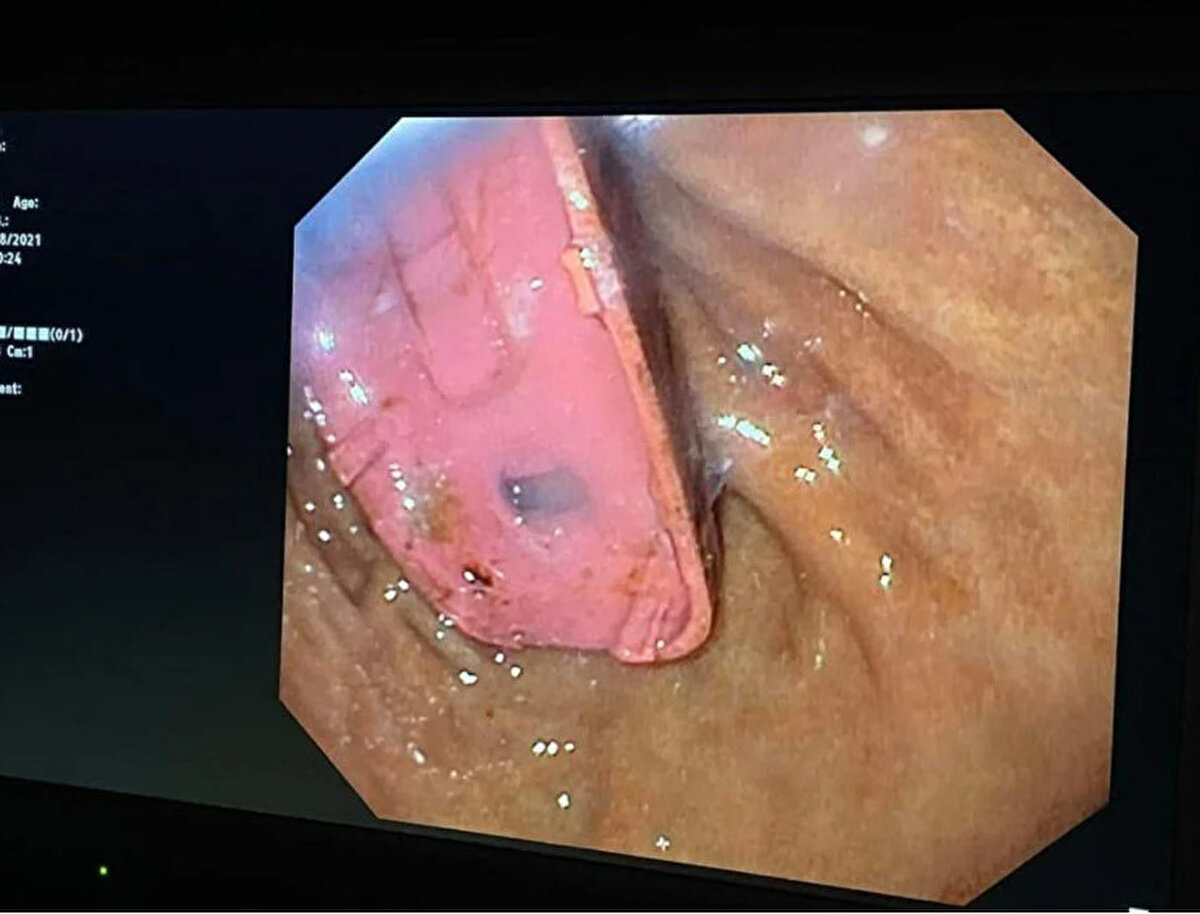 Bilim insanlarının bildirdiğine göre, yenmeyen, yanlışlıkla veya kasıtlı olarak yutulan yabancı nesnelerin yaklaşık yüzde 80'i, herhangi bir belirtiye neden olmadan vücuttan atılıyor.
Ancak, büyük, keskin veya zehirli maddelerin yutulması, çıkarılması için acil tıbbi müdahale gerektiriyor. Yenilebilir olmayan bir yabancı cismi yutmak, ne olduğuna ve sindirim kanalının neresinde olduğuna bağlı olarak çeşitli semptomlara neden olabiliyor.
Örneğin mide veya bağırsaklardaki yabancı cisimler, karında ağrı, şişkinlik, iştahsızlık, bulantı, kusma, ateş, dışkıda kan ve ishal veya kabızlık gibi semptomlara yol açabilir.Öte yandan, adamın yuttuğu telefonun ilk versiyonu 21 yıl önce sürüldü. Cihaz, kısmen dayanıklılığı nedeniyle yıllar içinde bir kült haline geldi. Nokia, telefondan dünya çapında 126 milyon adet sattı.
