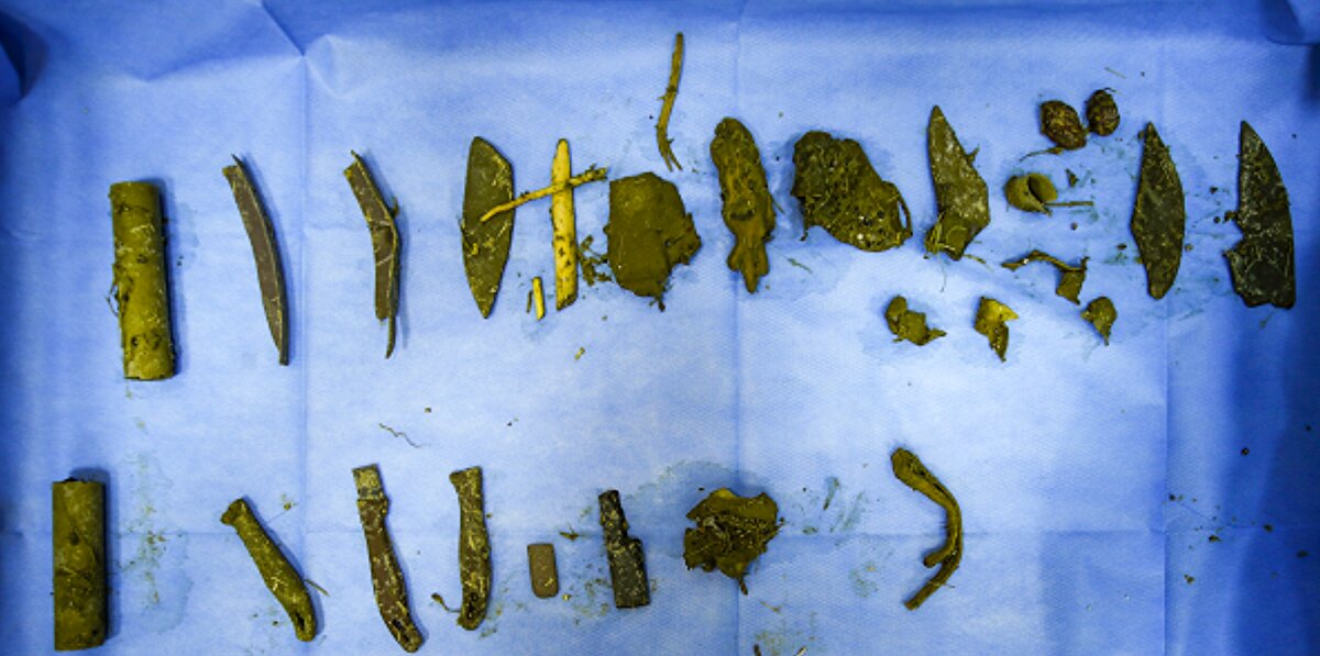 Prof. Dr. Sadık Yayla ise deve kuşunun midesinden yabancı cisimler çıkardıklarını aktararak, "Bunların birçoğu değişik büyüklükte plastik aksamlı su borusu gibi materyallerdi. Bunun dışında bıçak sapı ve çivi gibi yabancı cisimler de vardı. Bu cisimleri aldık ve operasyonumuzu tamamladık." dedi.<br>