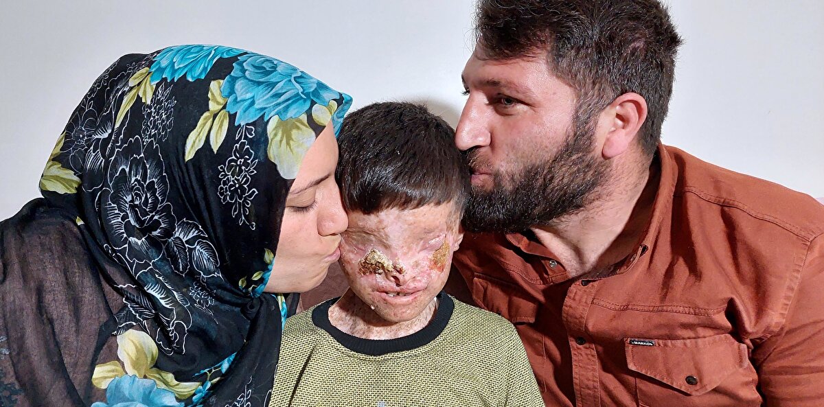 Oğlunun karanlık dünyasından çıkıp bugünlere gelmesinin bir mucize olduğunu belirten Yasemin İğneci ise "Destek veren herkese teşekkür ediyorum. İnşallah Salih'in gözleri de açılırsa bütün sıkıntımız bitecek. Artık yaraları da çıkmıyor. Çoğu yaraları hep kapandı. Köydeki evimizde Salih sürekli karanlık odada kalıyordu. Pansumanını falan her şeyi kendim yapıyordum. Şimdi ışığa çıkabiliyor. Ama yine doktorlarımızın önerisi güneşe fazla çıkmaması. Allah'ıma binlerce şükürler olsun önceki gibi yaraları yok. Artık pansumanını kendim yapmıyorum. O ilaç sayesinde yaraları kapandı. Şu anda sadece gözleri kaldı. İnşallah gözleri de açılırsa bizden mutlusu olmaz" ifadelerini kullandı.