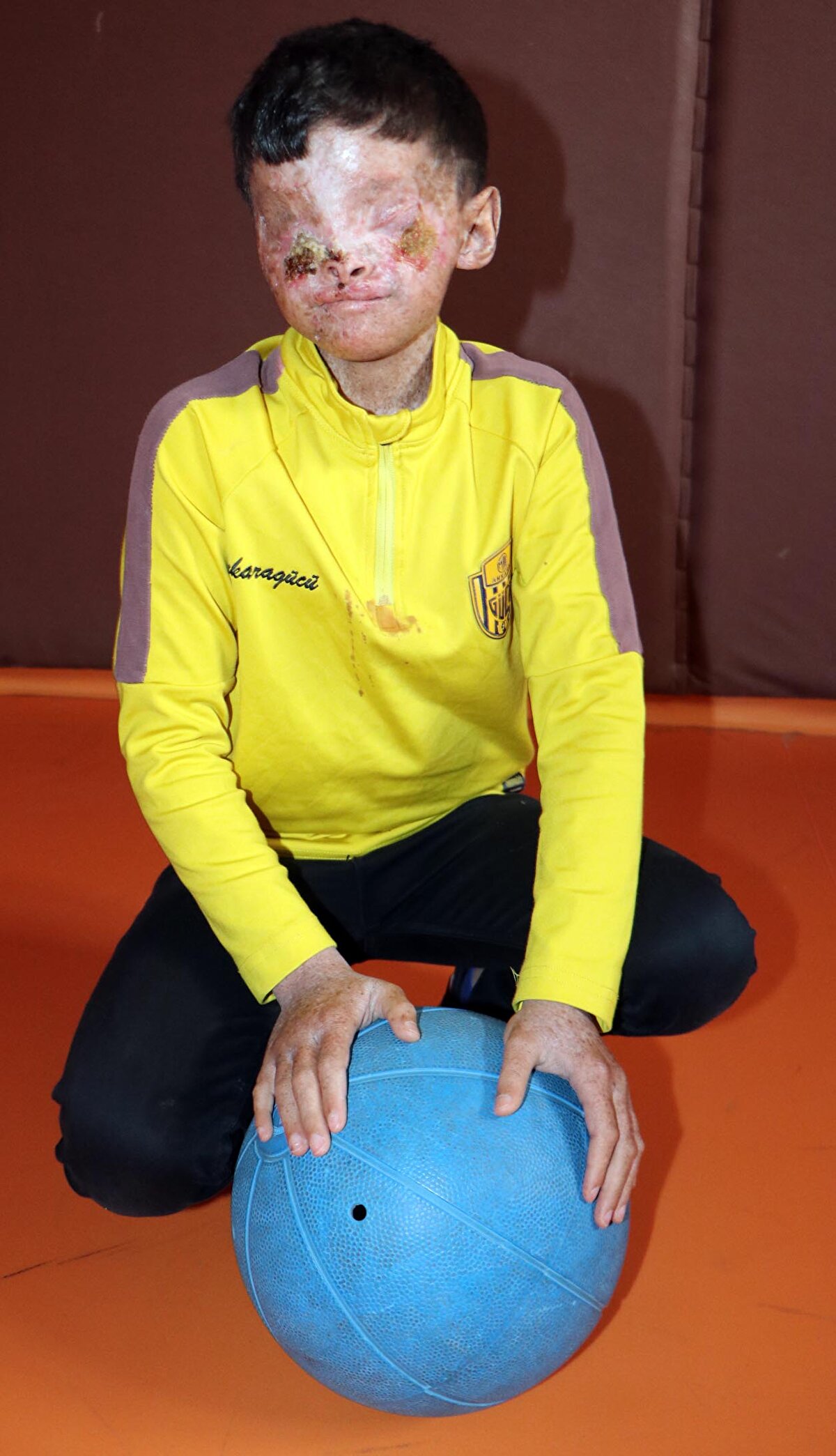 Salih İğneci de kendini çok iyi hissettiğini söyledi. Yüzündeki yaralar iyileştikçe ışığı daha çok algılamaya başlayan İğneci, görmeyi çok istediğini belirterek şunları söyledi:<br><br>"Önceden karanlık bir odadaydım, ışık göremiyordum. Mesela önceden hiç kendim yürüyemiyordum. Hep bir karanlık yerde duruyordum. Dışarıda bile yüzümü kapatıyorduk. Şimdi kendim yürüyebiliyorum, ışıktan rahatsız olmuyorum. Her ihtiyacımı kendim görebiliyorum. Ankara'ya da gidiyorum. Hatta Ankara'daki ilaçlarımı da kestiler. Gözlerim açılınca mesela abimlerle bisiklet sürmeyi hayal ediyorum.Erzurum'da tek başıma sokaklarda gezmek istiyorum. Annemi, babamı, kardeşlerimi de merak ediyorum. Okulda da mutluyum. Burada öğretmenim bize yazı yazmayı öğretiyor. Kitap okuyoruz. Teneffüslerde arkadaşlarımla oynuyorum." 