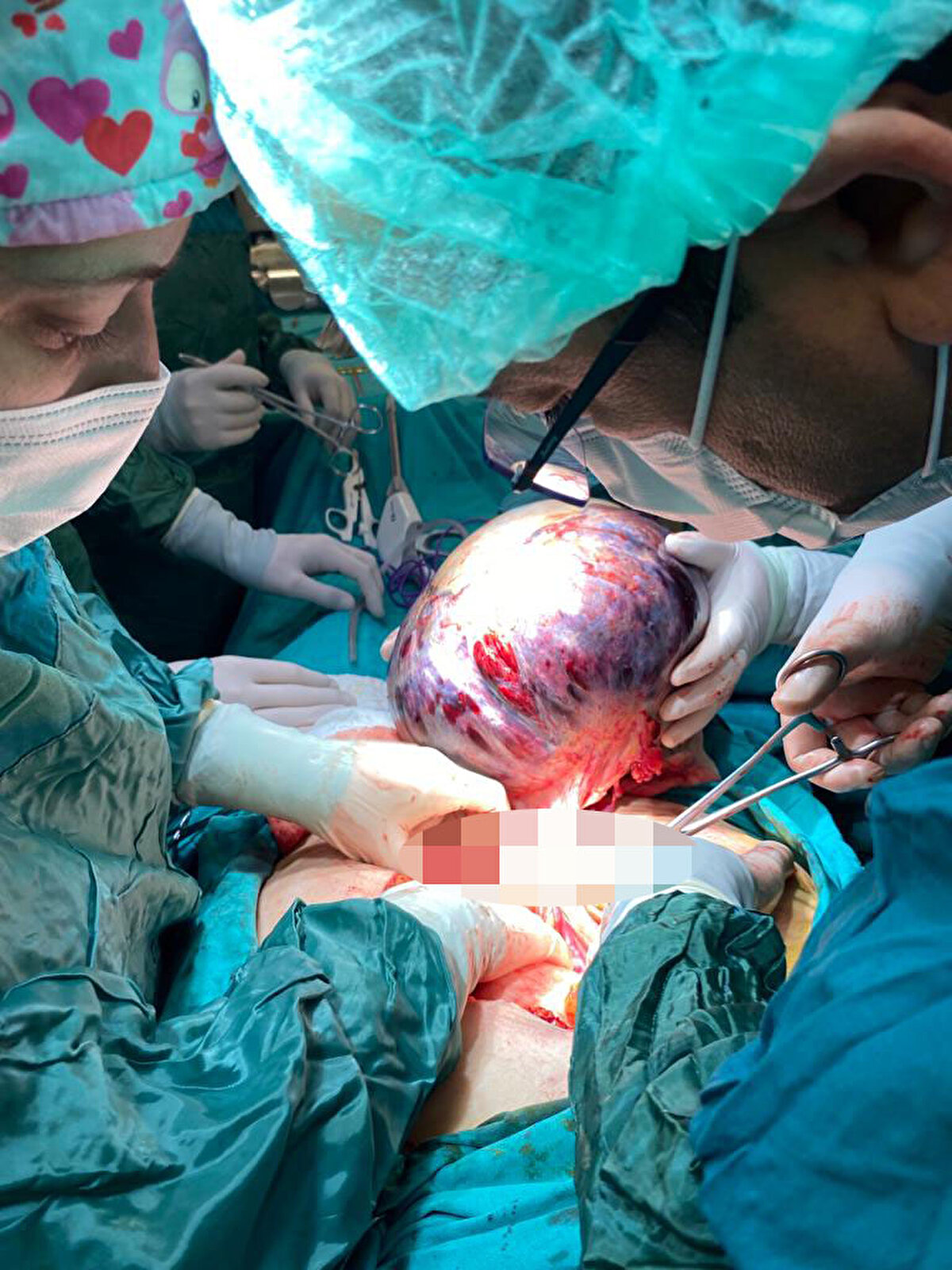 'BU KADAR BÜYÜK BİR KİTLEYE HİÇ RASTLAMADIM'<br>Operasyonu yapan doktorlardan SCÜ Tıp Fakültesi Cerrahi Tıp Bilimleri Bölümü Kadın Hastalıkları ve Doğum Ana Bilim Dalı Doç. Dr. Savaş Karakuş, "Kitaplarda 60 kiloya kadar karın içerisi dolduracak kitleler olabileceğini okuyorduk. Fakat 25 yıllık meslek hayatımda bu kadar büyük kitleye hiç rastlamadım. Leğen kemiğinden başlayıp, diyaframı yukarıya kaldıracak kadar büyük bir kitle. 10 kilo ağırlığında, 55 santimetre çapında. Büyük bir kitleyi ekibimiz ile başarılı bir şekilde çıkardık. Bu tür zor ameliyatlar ekip işi. Cumhuriyet Üniversitesi'nde bu tür ameliyatları başarıyla yapıyoruz. Bu büyük bir ameliyat ve kendine göre komplikasyonları var. Ameliyat öncesi, olabilecek her şeyi anlatarak imza aldık. Operasyonumuz 4 saat sürdü. Anlattığımız komplikasyonların hiçbiri gerçeklemeden ameliyatımızı bitirdik. Hastamız çok iyi biz de mutluyuz" dedi.