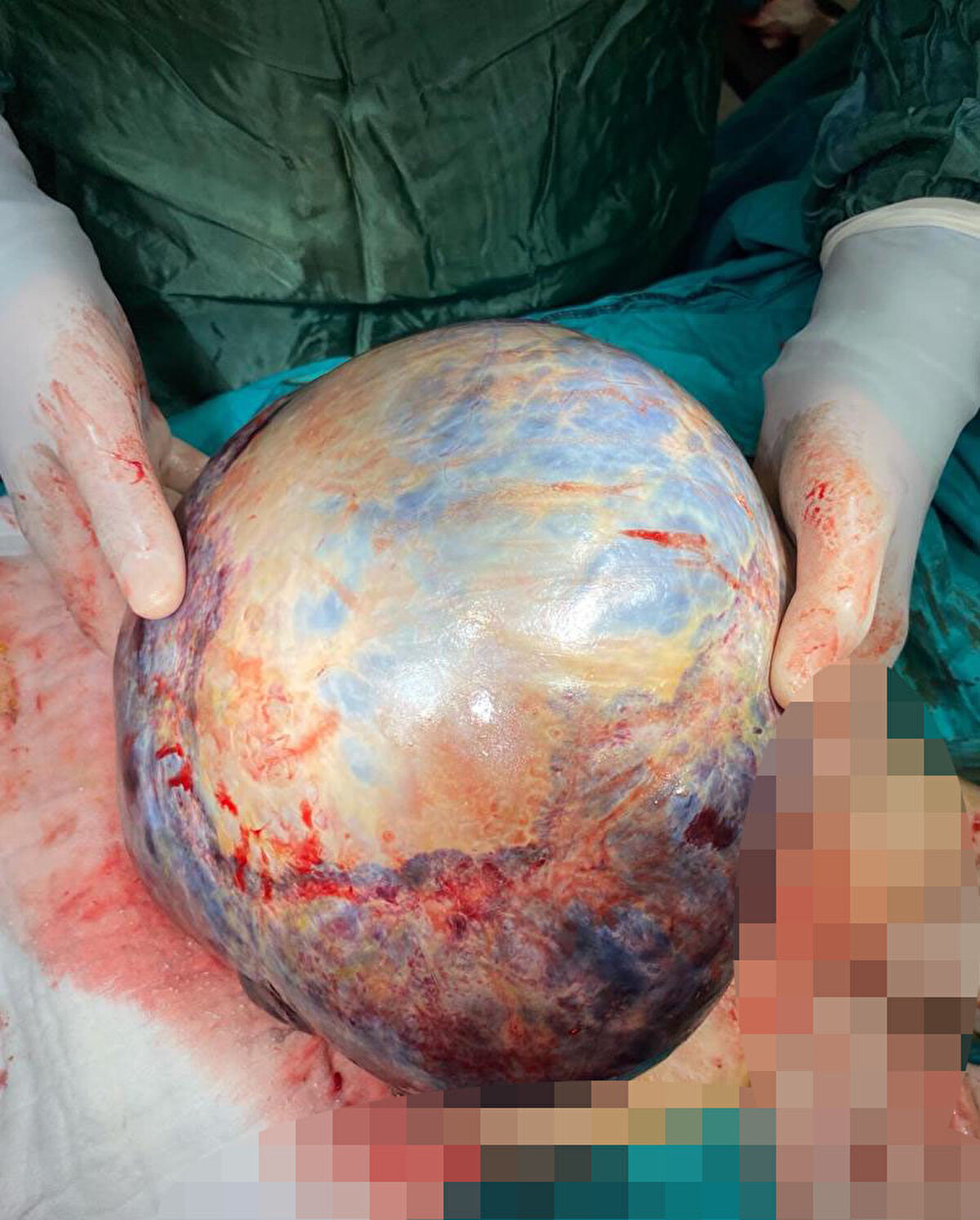 'ZOR AMA BAŞARILI BİR AMELİYAT OLDU'<br>SCÜ Tıp Fakültesi Cerrahi Tıp Bilimleri Bölümü Kadın Hastalıkları ve Doğum Ana Bilim Dalı Dr. Öğretim Üyesi Dilay Karademir ise hastanın sıkıntılı bir şekilde kendilerine geldiğini belirterek, "Türkan Hanım nefes darlığı ve karında şişlik şikayetiyle hastanemize geldi. Yaptığımız bütün tetkikler sonucunda kitle olduğunu tespit ederek, ameliyat kararı verdik. Zor ama başarılı bir ameliyat oldu. Kitleyi çıkardık ve hastamızı sağlıklı bir şekilde taburcu ettik" ifadelerini kullandı.