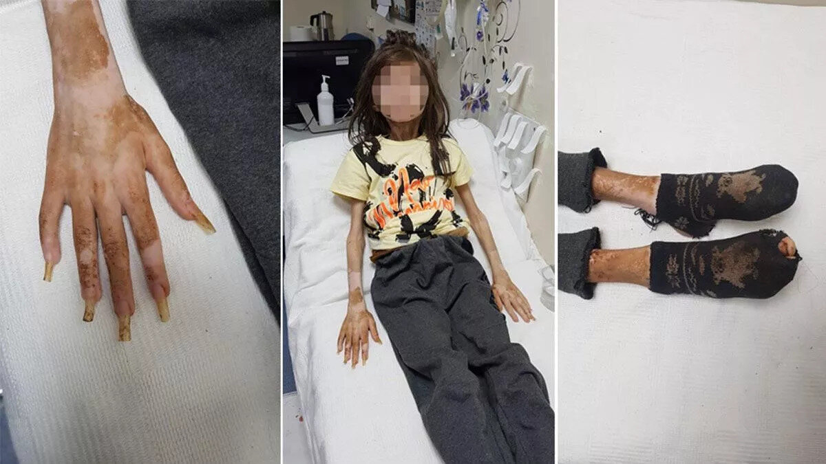 'CİDDİ BİR BESLENME GERİLİĞİ OLMUŞ'<br><br>Cem Muhammet'in ağırlıklı olarak protein ağırlıklı beslendiğini ifade eden Prof. Dr. Özkan, "Beslenme geriliği olduğu için bizim gibi Yemek yemiyor. Daha özel bir şekilde Diyet rejimi hazırlanması gerekiyor. Kalori hesapları yapılıyor. Çok fazla verilmiyor. Çok hızlı yüklenmiyor, çünkü bazı sendromlar ortaya çıkıyor.