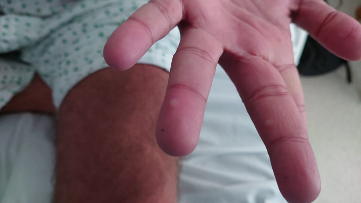 ÖNCE HIV TEŞHİSİ ALDI SONRA KOVİD OLDU "EN KÖTÜSÜ BUYDU" DEDİ<br>HIV pozitif teşhisi alması da dahil, yaşadığı hiçbir deneyimin buna benzemediğini vurgulayan Tulunay, hastalığın yarattığı belirsizlik yeterince kötüyken, bir de üstüne damgalanarak yaşamanın çok daha sarsıcı olduğuna dikkat çekerek, "HIV'e yakalandığım zaman semptomsuzdum, tedaviye başlandı ve hiçbir yan etkisi olmadan viral yüküm sıfırlandı, çok şükür bulaştırıcılığım bitti. İki kere Kovid geçirdim. Aşılarım sayesinde hafif geçti. Onlarda bu kadar korkmamıştım. Maymun çiçeğinde hastaneden çıktıktan sonra bütün lezyonlar yok olana kadar evinizde kapalı kalmak zorundasınız. Bunun ne kadar süreceği de belli değil. Hani Kovid'de 10-14 gün diyorduk örneğin. Bütün o belirsizlikler, psikolojik olarak acayip yıprattı. Ama en çok da hastalık deneyimimi paylaştıktan sonra (sosyal medyada) insanlardan gelen negatif tepkiler yıpratıcı oldu. İngiltere'de bir HIV derneğinde eğitim koordinatörü olarak çalışıyorum. İnsanlar ne yazık ki HIV konusunda da 30-40 yıl önceki bilgilerle, o 'AIDS'e dönmüş' HIV vakalarında kaldıkları için, HIV'e de hala damgalama ile yaklaşıyorlar. Şimdi maymun çiçeğinde de aynı damgalamaları görüyoruz ne yazık ki. Oysa bu hastalıkla ilgili çok fazla yanlış bilgi yayıldı" dedi.<br>