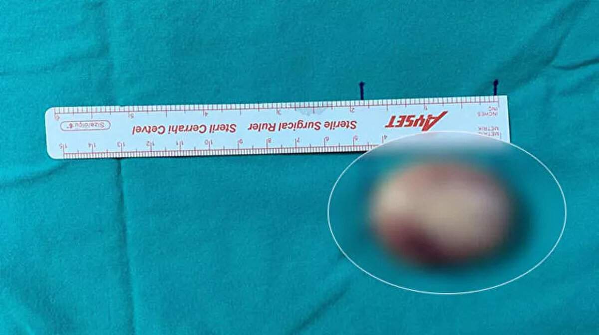 'AİLEMDEN BİRİ SABAHA KADAR YANIMDA BEKLİYORDU'<br>Ameliyat sonrası yaşam kalitesinin arttığını söyleyen Ertuğrul Engin de "Rahatsızlığımdan dolayı birkaç sağlık merkezine gittim ama hiçbir sonuç alamadım. 2 yıldır yemek yerken çok zorlanıyor, nefes alamıyordum. Özellikle uyuduğum zaman nefesim tamamen gittiği için ailemden biri sabaha kadar yanımda bekliyordu. Yapılan ameliyat sonrası rahat nefes almaya başladım. Doç. Dr. Mehmet Emre Sivrice, Dr. Bekir Büyükçelik ve ekibine çok teşekkür ederim" diye konuştu. 