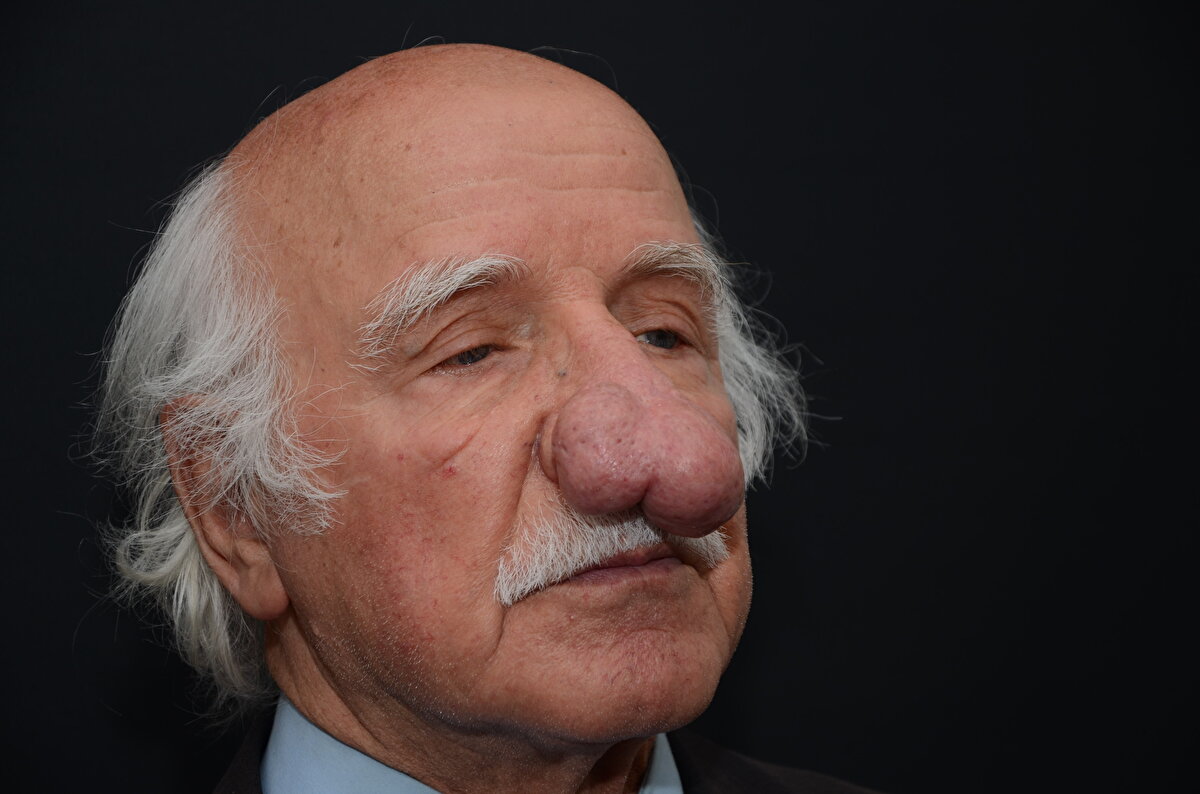 Of ilçesinde yaşayan Faik Ramoğlu, yaklaşık 2 yıl önce burnunda oluşmaya başlayan kitleyi başlangıçta önemsedi. Kitle zamanla büyümesine rağmen COVID-19 salgını nedeniyle hastaneye gitmeye çekinen Ramoğlu, nefes almakta ve aşağı bakmakta zorlanmaya başladı.Ailesi ve çevresindekilerin telkinleriyle Of Devlet Hastanesi'ne giden ve kulak burun boğaz uzmanı Operatör Dr. Erdal Rahman Köprücü ile görüşen Ramoğlu'nun tedavisine başlandı.<br>