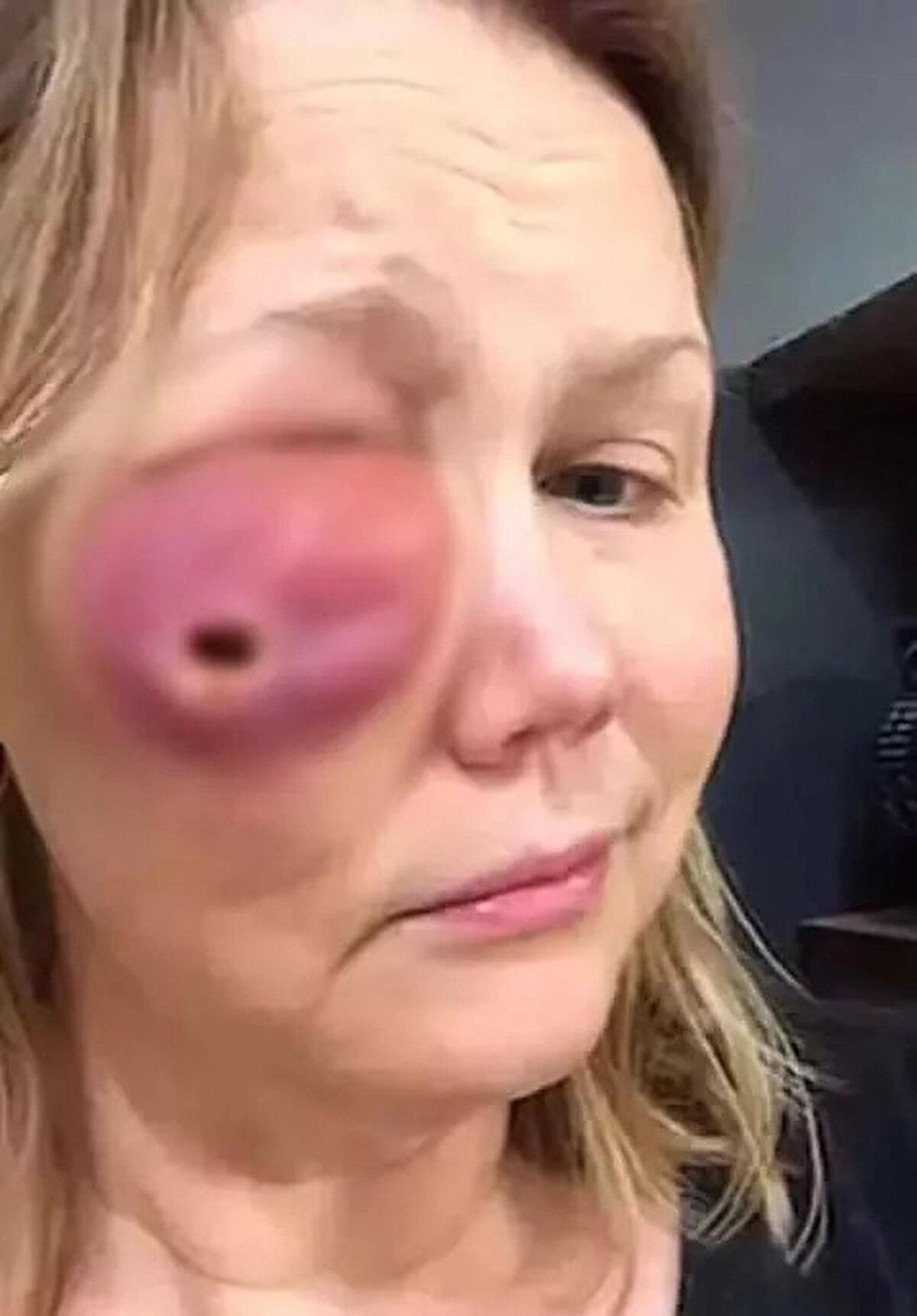 Dolgu yaptırdığını zanneden kadın 4 yılın sonunda aslında yüzüne silikon enjekte edildiğini öğrenince büüyk bir şaşkınlık yaşadığını dile getirerek, “Bir meslektaşım benim için dolgu yapmayı teklif etti ve 40'lı yaşlarımda gibiydim, biraz daha iyi görüneceğim ve restylane veya juvederm aldığımı düşündüm, ama silikondu." dedi.Gina, sorunu yüzünün sadece bir tarafında yaşadığını ancak sol yanağında silikon bulunmadığını söyledi.<br><br>