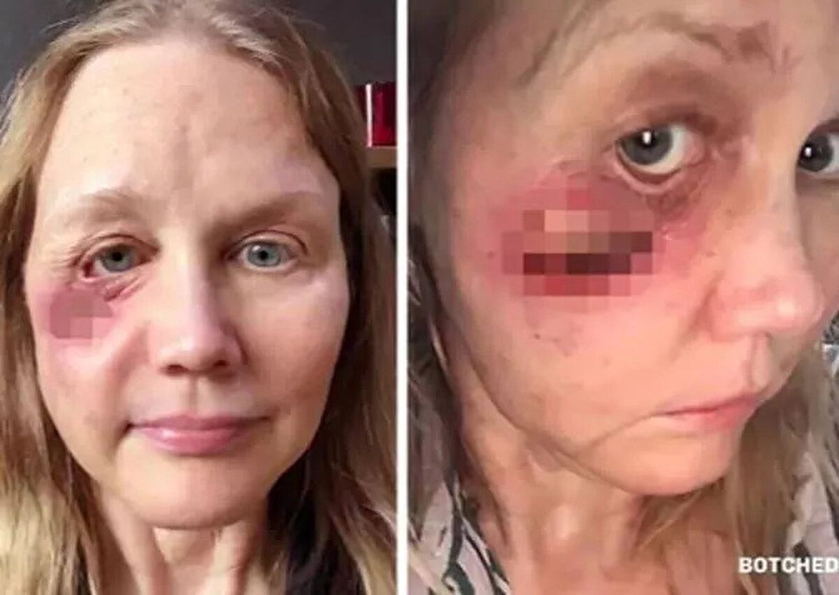 Ameliyatlarından sonra sağlık durumunun bir türlü iyileşmediğini belirten Anderson, “Birinci işlem sonrası sorun görünmüyordu, granülomu çıkardılar ama geri geldi. Dört ay sonra silikonu çıkarmaya çalıştılar ancak bu da işe yaramadı çünkü granülomlar tekrar oluştu.İlerleyen bir ayda ise çok daha kötü bir hal aldı. Hatta granülomlar yanağımda bir delik açtı ve hatta cildi yeniden tutturmak için alt göz kapağı bölgesine bir kanat yaptılar” dedi.<br><br>