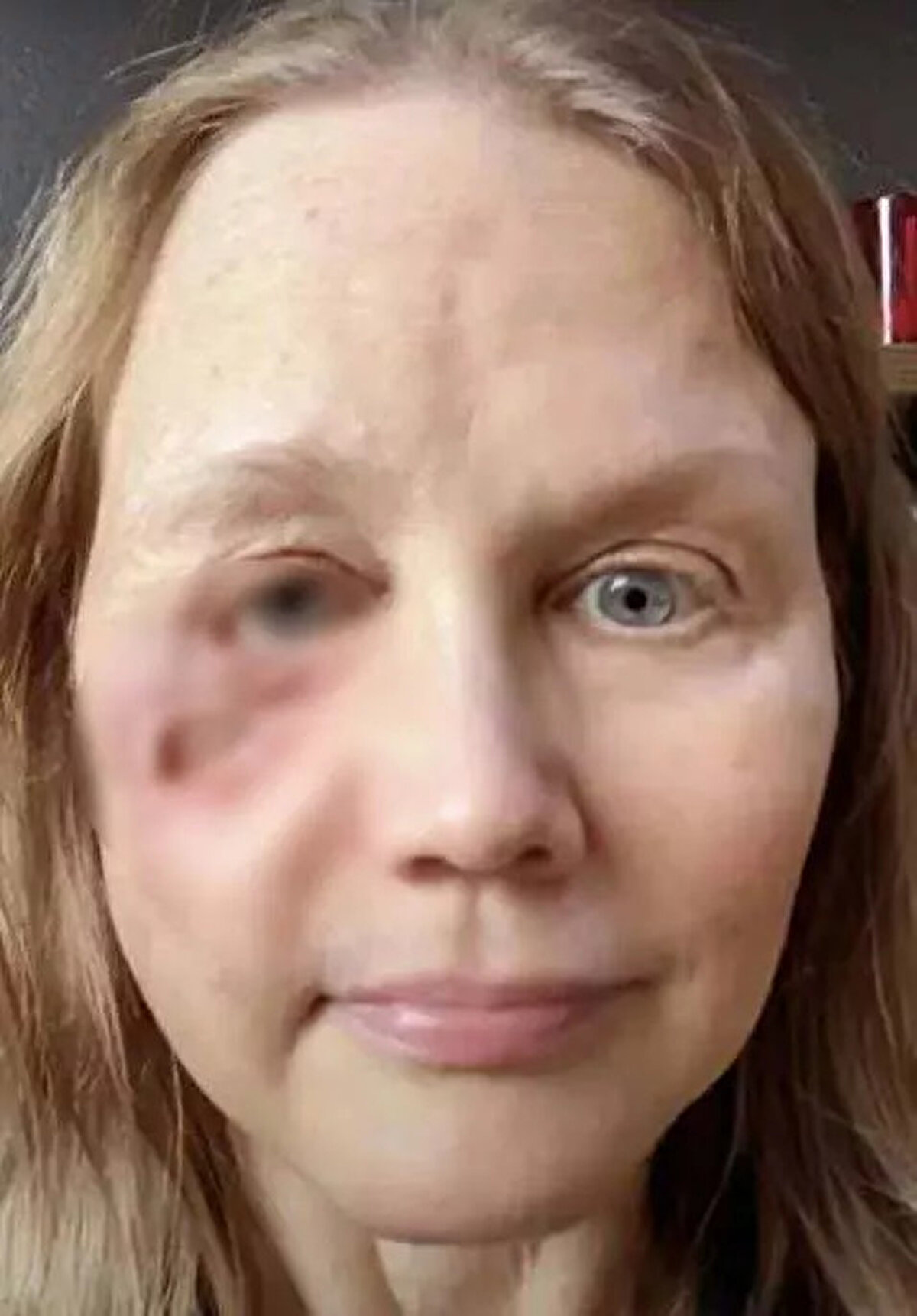 Zamanla Anderson’un bedeni estetik işleme tepki göstererek inflamatuar reaksiyon oluşturdu. Gittikçe kötüleşen reaksiyon zamanla devasa bir granülom haline geldi.<br><br>