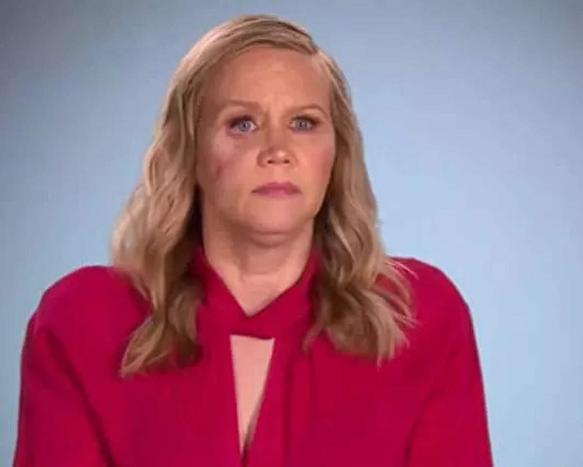 İngiltere’de yaşayan Gina Anderson isimli bir kadın yüzüne dolgu yaptırmak istedi. Ancak göz altlarına yaptırdığı işlem 4 yılın sonra cildinde ciddi reaksiyonlar oluşturmaya başladı. Anderson yıllar içinde yüzüne dolgu yerin silikon takıldığını öğrendi ve sağ gözünün altı kısmı görenleri şaşkına uğratacak şekilde şişmeye başladı. <br><br>