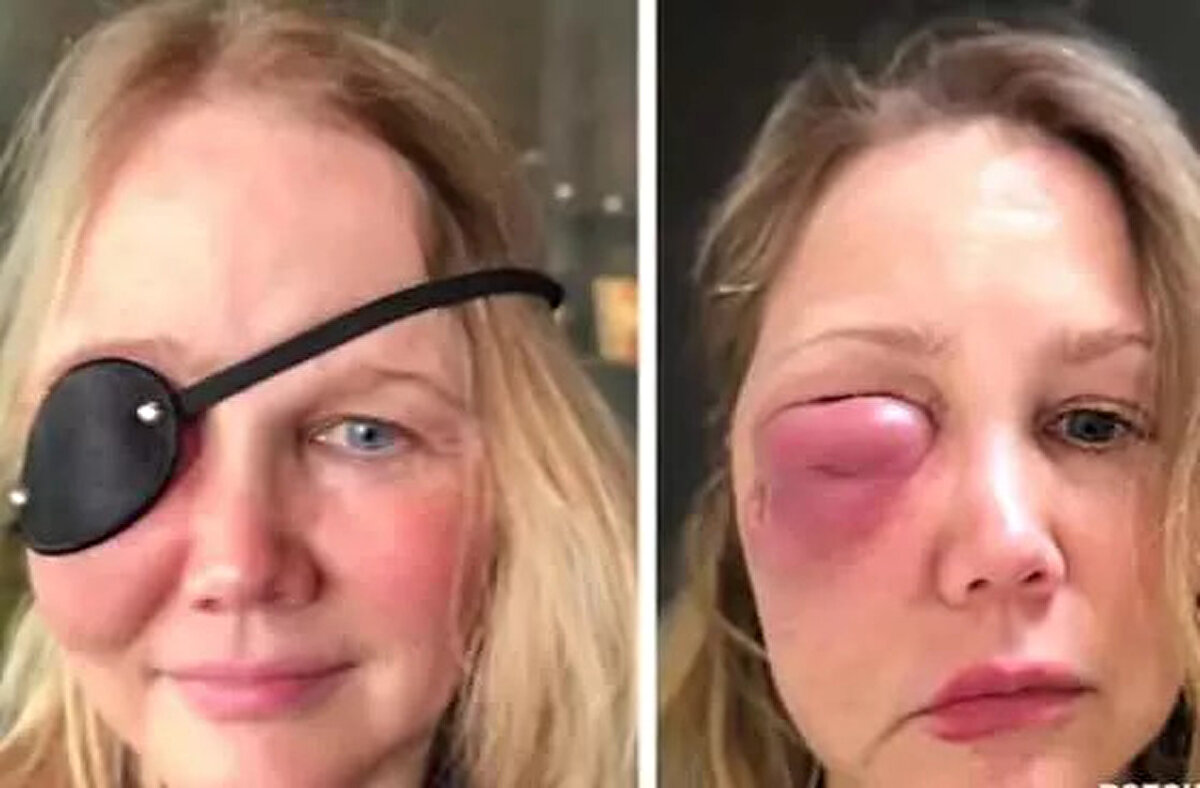 Yüzünde oluşan granülomu fark ettiğinde doktora başvurduğunu ifade eden Anderson, sorunu düzeltmek için beş ameliyat daha geçirdiğini söyledi. <br><br>