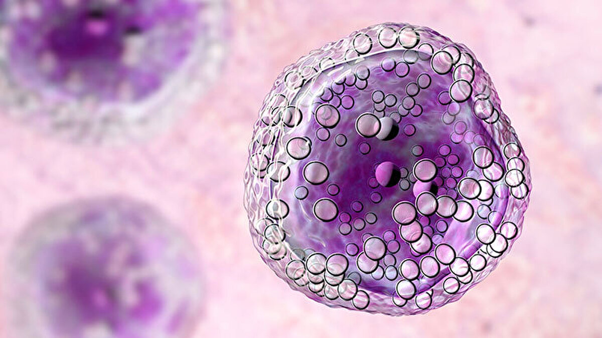 6 ayda yüzde 10'un üzerinde kilo kaybı "lenfoma" habercisi olabilir<br><br>İleri yaş, immün sistemin baskılanması, bazı otoimmün hastalıklar ile çevresel etkilerin, lenfoma risk faktörleri arasında yer aldığını anlatan Özet, hastalığın her yaş grubunda görülebildiğini ama yaşın ilerlemesinin riski artırdığını söyledi.<br><br>Prof. Dr. Özet, "Hastalarımız sıklıkla bize boyun, koltuk veya kasıklarda büyüyen lenf bezleri ile başvuruyor. Lenf bezleri enfeksiyon gibi başka nedenlerle de büyüyebilir ama enfeksiyon geçtiğinde normale döner. Normale dönmeyen, ağrısız büyüyen lenf bezlerinde mutlaka hekime başvurulması gerekir. Bunun dışında 38 dereceyi aşan ateş, 6 ayda yüzde 10'un üzerinde kilo kaybı, terleme gibi belirtiler de söz konusu." diye konuştu.