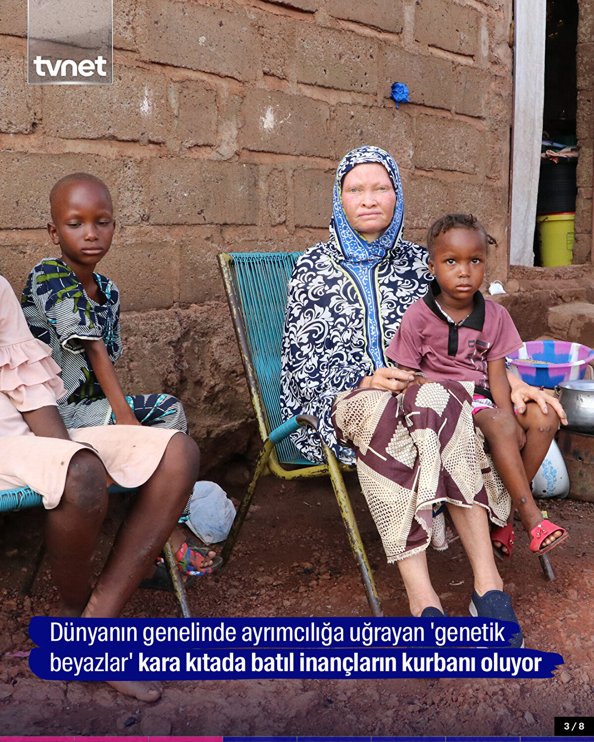 Dünyanın genelinde ayrımcılığa uğrayan 'genetik beyazlar' kara kıtada batıl inançların kurbanı oluyor