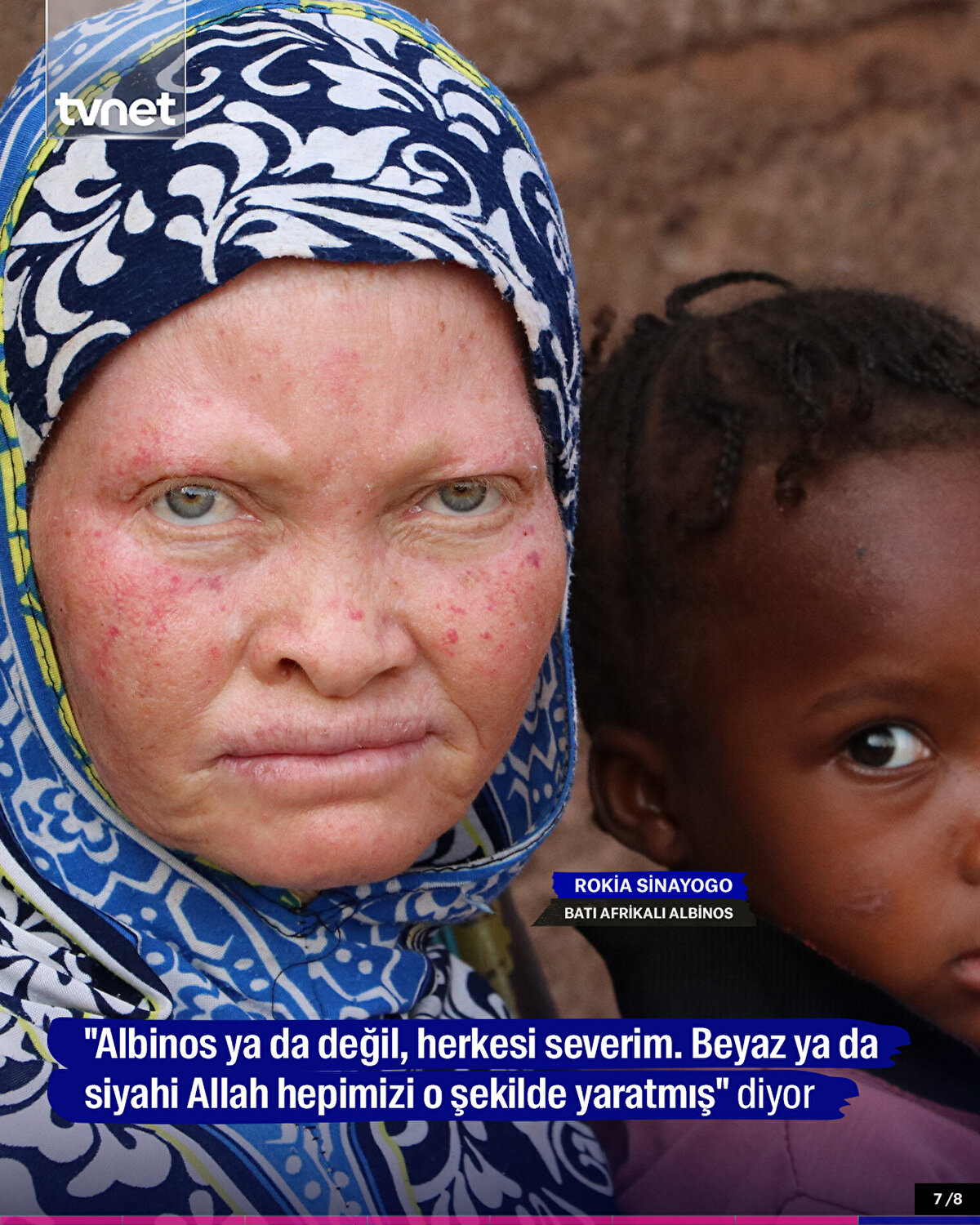 "Albinos ya da değil, herkesi severim. Beyaz ya da siyahi Allah hepimizi o şekilde yaratmış." diyor