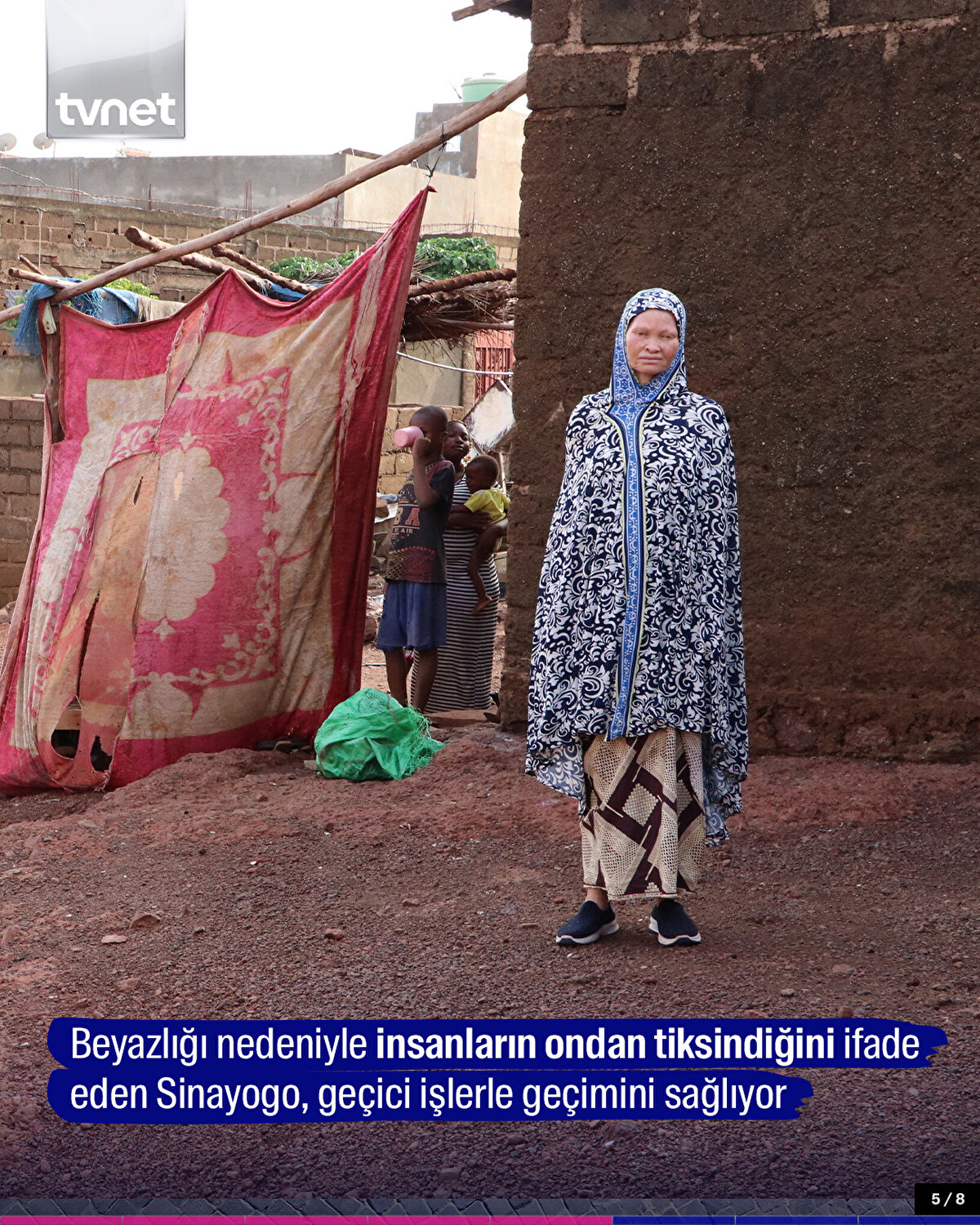 Beyazlığı nedeniyle insanların ondan tiksindiğini ifade eden Sinayogo, geçici işlerle geçimini sağlıyor