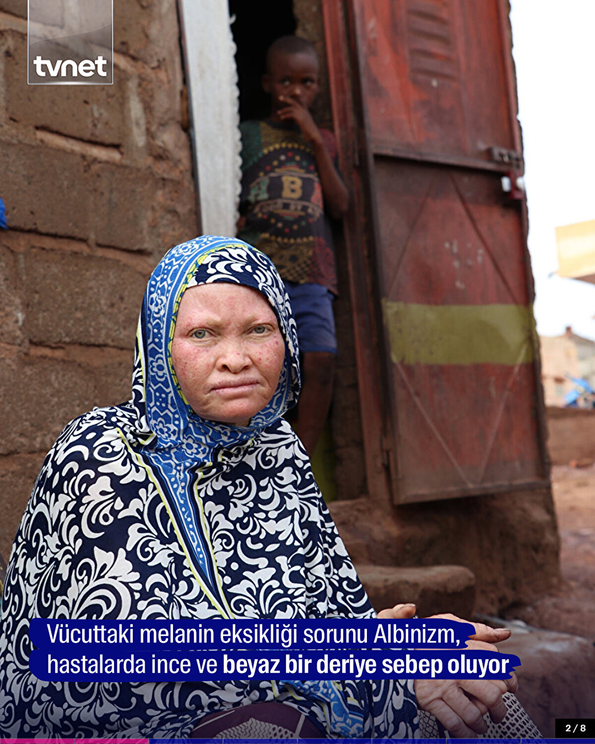 Vücuttaki melanin eksikliği sorunu Albinizm, hastalarda ince ve beyaz bir deriye sebep oluyor