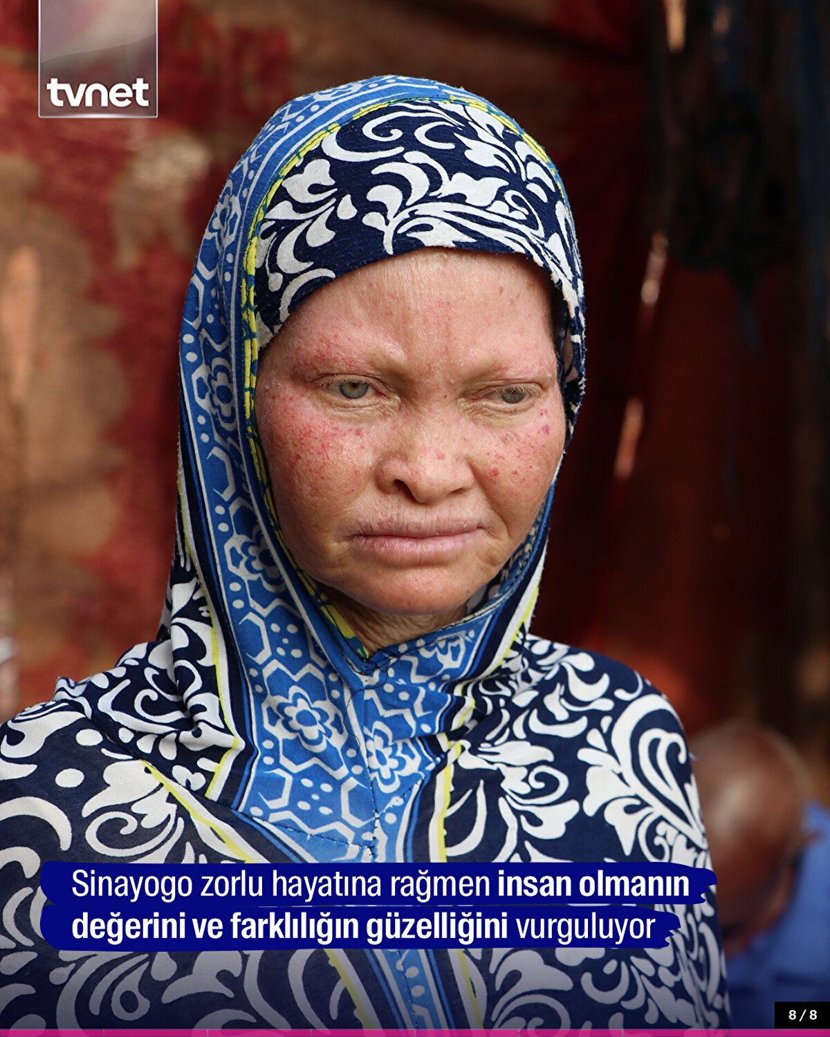 Sinayogo zorlu hayatına rağmen insan olmanın değerini ve farklılığın güzelliğini vurguluyor
