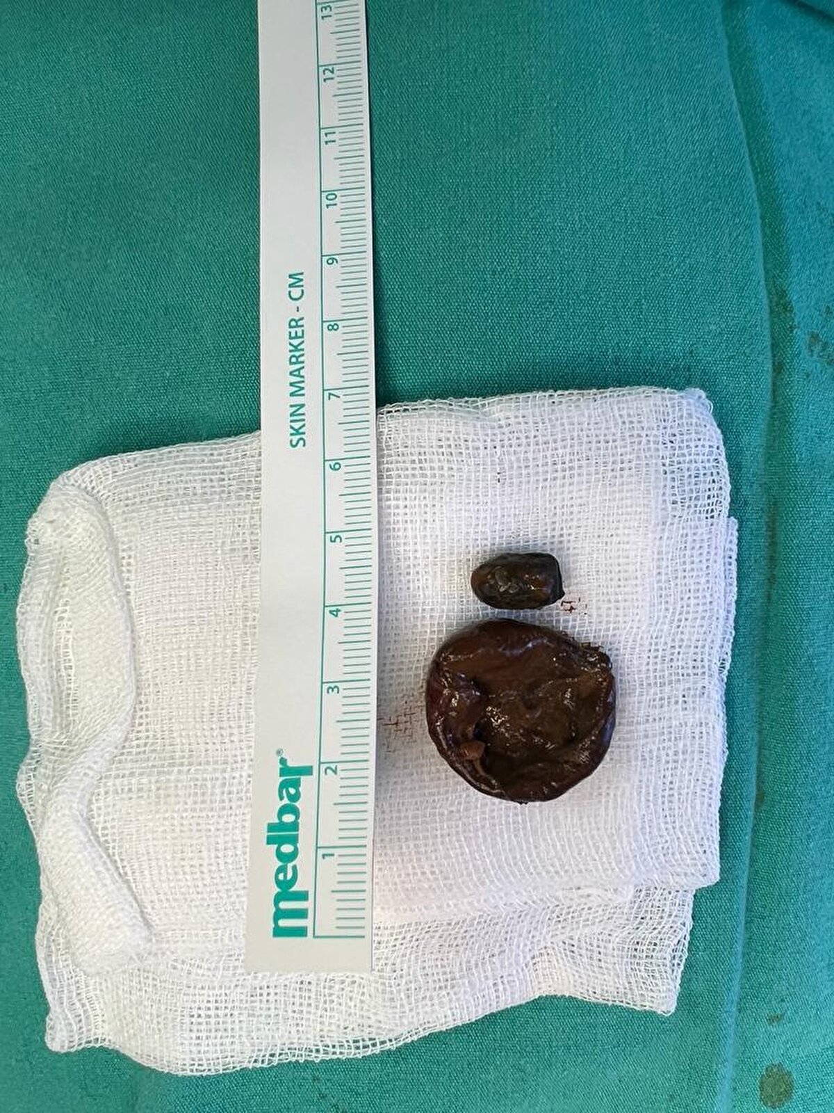 13 yaşındayken kendisine kurşun saplandığını söyleyen Koca, “O an burnum yanmıştı. Olay olduğunda 13 yaşındaydım. Sonrasında bir zararı olmadığı için aldırmadım. İstanbul'da ameliyata riskli dediler, bir de korona vardı. Orada da aldırmadım. Herkes bir şeyle gidemiyor öbür dünyaya diye düşünüp 'ben bir kurşunla gideyim' dedim, aldırmadım. İstanbul'da özel bir doktora gitmiştik. 'Ameliyat riskli bence aldırmasan iyi' dedi. 'Niye' dedim; 'Beyin damarlarınla göz damarların burnuna denk geliyor' dedi ben de vazgeçtim" diye konuştu.