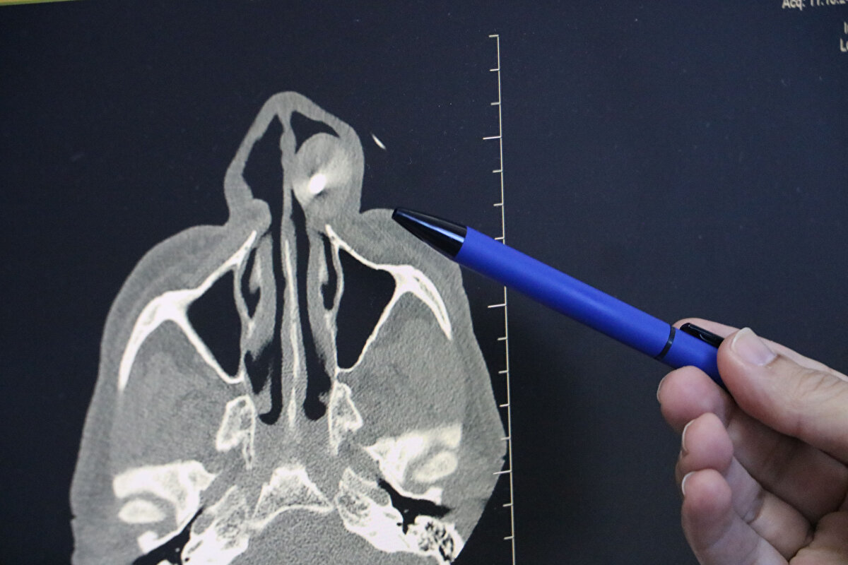 İnsanın kurşunla yaşamasının sorun olabileceğini belirten Doç. Dr. Deniz Baklavacı, “Hastanın hikayesini sorguladığımızda, tesadüf eseri yüzüne gelen bir kurşunun içerde kaldığı ve çıkarılmadığını öğrendik. Bununla ilgili komplikasyonlar oluşabilirdi, sonuçta metalik yabancı bir cisim. Ancak hastanın şansı şu ki; kurşun vücut tarafından bir koruyucu dokuyla kaplanmış ve kitle halini almış. Yan etki yapmamasının nedeni büyük ihtimalle yabancı cismin doku ile korunaklı hale gelmesiydi" dedi.<br>Merminin yüz kemiğinde, dişlerin üzerinde 'maksilla' adı verilen bölgede olduğunu ifade eden ve burun bölgesinden işlem yapılan Baklavacı, “Bu hasta görülebilecek çok nadir bir tabloydu. Ben de meslek hayatında ilk defa karşılaştım" diye konuştu.