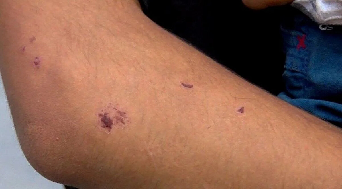 Normal sivrisineğe oranla daha büyük yaralar bırakan 'Aedes' türünün megakentte yayılımı artınca belediyelerin de çalışmaları hız kazandı.<br><br>Bu belediyelerden olan Bağcılar, ilaçlamanın yanında halkı korunma yöntemlerine karşı bilinçlendirmeye çalışıyor.