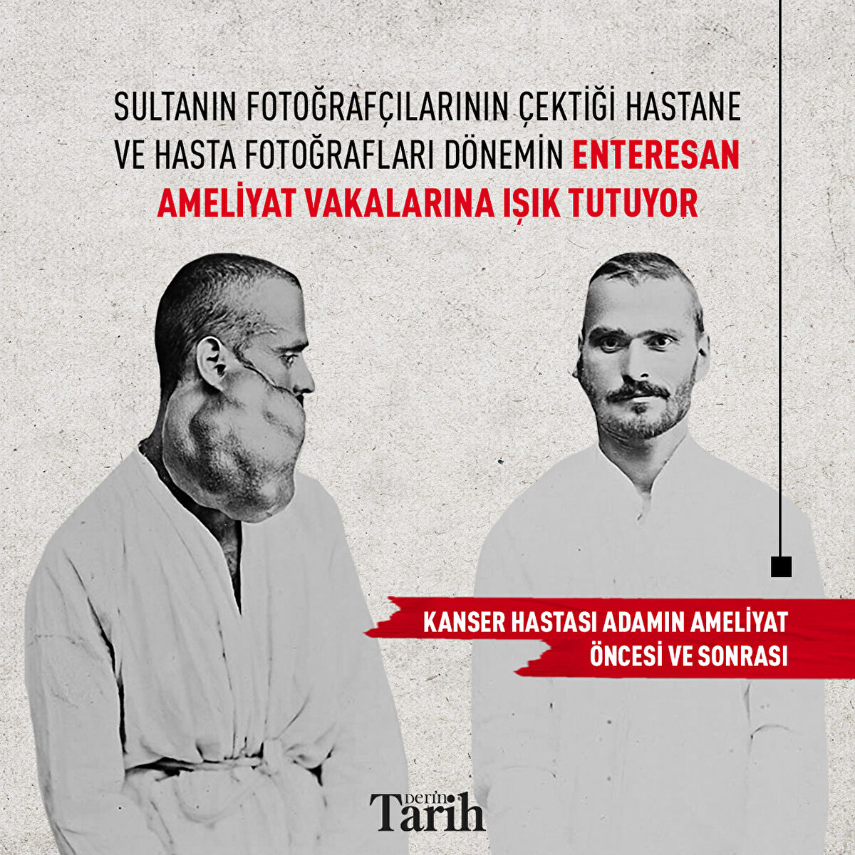 Sultanın fotoğrafçılarının çektiği hastane ve hasta fotoğrafları dönemin enteresan ameliyat vakalarına ışık tutuyor
