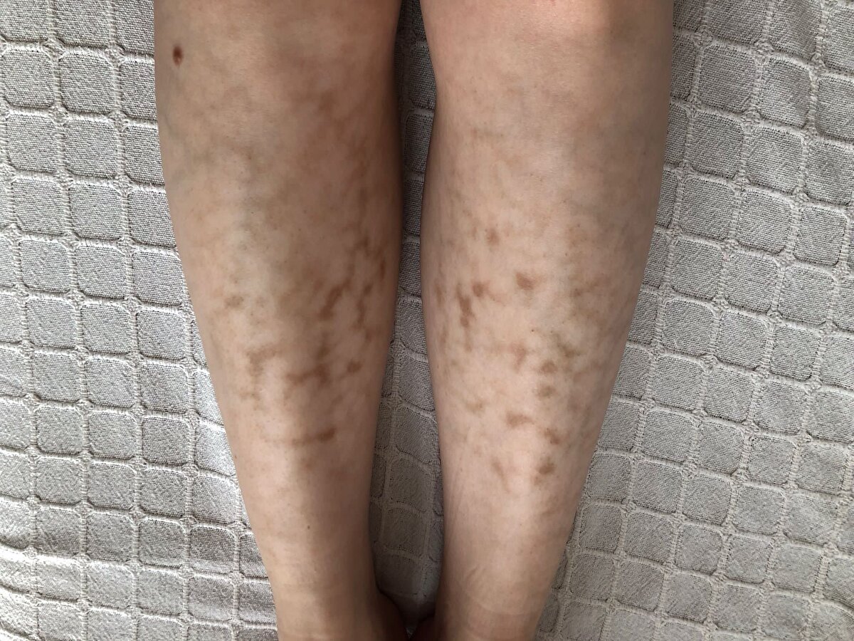 "KAŞINTI VE KIZARIKLIKLA ORTAYA ÇIKIYOR"<br>Hastalığın ilk belirtileri hakkında da açıklamalarda bulunan Başaran, "Öncesinde hafif kaşıntılar olabilir. O bölgenin kızarması gibi durum görülebilir. Hastaların bize genelde korkarak başvurması ağ şeklinde görülen çok koyu renkli pigmentasyonların olmasıyla kaynaklanıyor. Hafif bir kaşıntı ve kızartı hastalığın ilk belirtisi oluyor" dedi. Başaran, "Dizüstü bilgisayarın direkt kendisinden kaynaklanmıyor, verdiği ısıdan kaynaklanıyor. Sırtta çantanın içinde taşınırken bilgisayar çalışıyor olursa yine ısı verebilir. Çok uzun süre kullanıyorsa telefon da ısınıyorsa ve kulağında, yüzünde tutuyorsa burada olmaz diyemeyiz. Bizim için bu hastalıkta önemli olan aynı bölgenin ısıya maruz kalması ve uzun süreli ve tekrar ediyor olması. Birkaç günde olmaz en azından birkaç ay boyunca bu ısı maruziyetinin devam ediyor olması gerekiyor. Kıyafetle temastan da geçebiliyor" ifadelerini kullandı. Başaran, "Başka bir hastalığı tetikleyici durumu yok ama aynı bölgede başka bir dermatolojik rahatsızlık varsa bununla ilgili hem tanı konmasını zorlaştırabilir hem de tedaviyi zorlaştırabilir. Tedavisi de durumun yaygınlığına ve o anki ağırlığına bağlı. Kremlerle, ilaçlarla da tedavi edilebilir. Ya da lazer tedavisi gerektirebiliyor. Çok sık olmasa da böyle hastalarımız ve lazer tedavisiyle gerilettiğimiz hastalarımız var" diye konuştu.