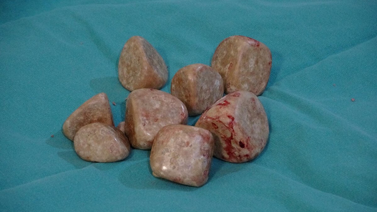 “Hayrettin Bey'i hemen ameliyata aldık. Kendisi daha önce de bir bağırsak ameliyatı geçirdiği için karın bölgesi yapışıktı. Bizler de 2 santimlik bir kesiden buradaki 20 taşı çıkardık.