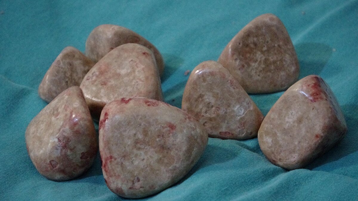 Çanakkale’de 30 yaşındaki Hayrettin Gültekin, idrar yanması ve karın ağrısı şikayetiyle Çanakkale Onsekiz Mart Üniversitesi (ÇOMÜ) Hastanesi'ne başvurduğunda mesanesinde en küçüğü 3-5 santimetre ebatlarında, 20 taş olduğunu öğrendi.<br><br>