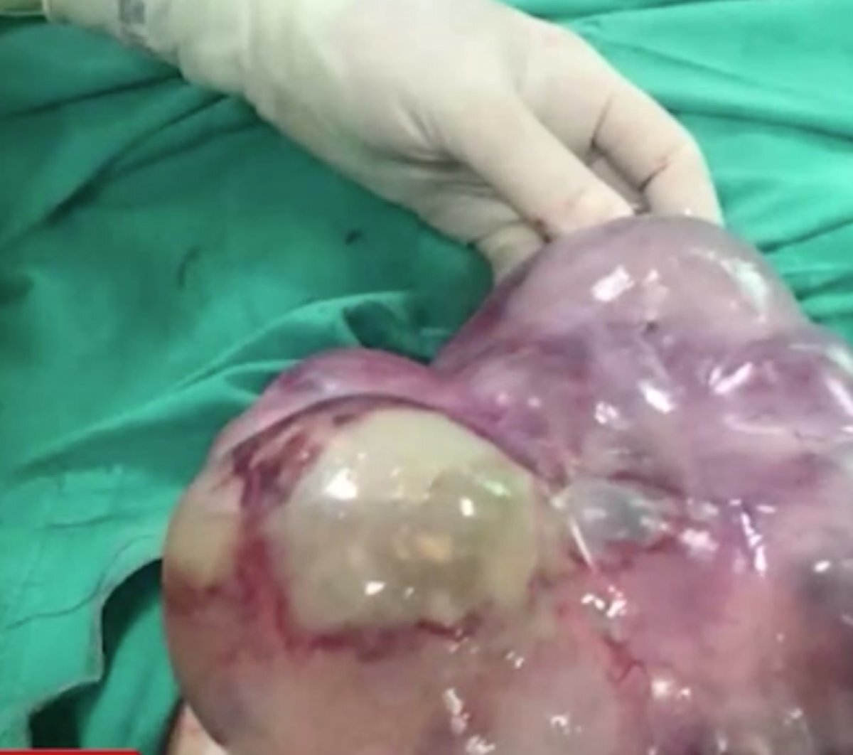 Hastane Başhekimi ve Çocuk Cerrahisi Uzmanı Doç. Dr. Veli Avcı ile Kadın Hastalıkları ve Doğum Uzmanı Op. Dr. Ağahan Han tarafından yapılan ameliyatta, çocuğun karın bölgesinden 30 santimetre uzunluğunda, 25 santimetre genişliğinde ve 7,5 kilogram ağırlığında kitle çıkarıldı.<br><br>Çocuk yaşlarda nadir görüldüğü belirtilen kitle, incelenmek üzere patoloji laboratuvarına gönderildi.<br><br>"Hastanın durumu iyi"<br>Doç. Dr. Avcı, AA muhabirine, hastanın aşırı karın şişkinliği, iştahsızlık, bulantı ve halsizlik gibi şikayetlerle hastaneye getirildiğini söyledi. 