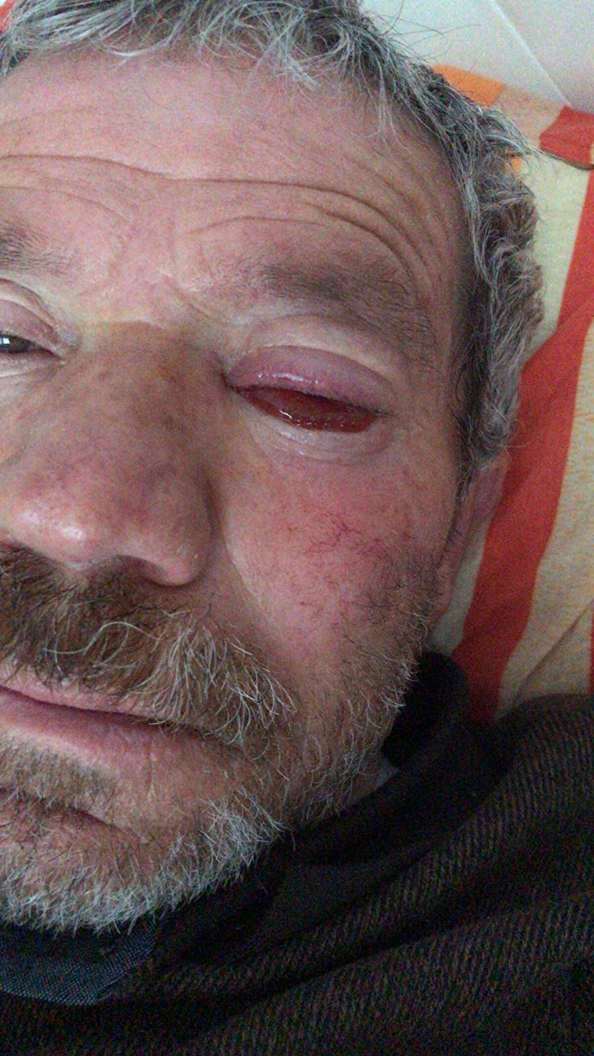 Ameliyatın ardından taburcu olan Aydın, ağrıları devam edince yeniden özel hastaneye geldi.<br><br>Burada 3 kez daha ameliyat geçiren Aydın iddiaya göre, enfeksiyon kapan sol gözünde görme yetisini kaybetti. Tedavi sürecinde gözünden alınan numunelerin incelenmek üzere başka hasta ismiyle devlet hastanesine gönderildiğini öne süren Aydın, suç duyurusunda bulundu. Şikayet üzerine hastaneler hakkında adli ve idari soruşturma başlatıldı.