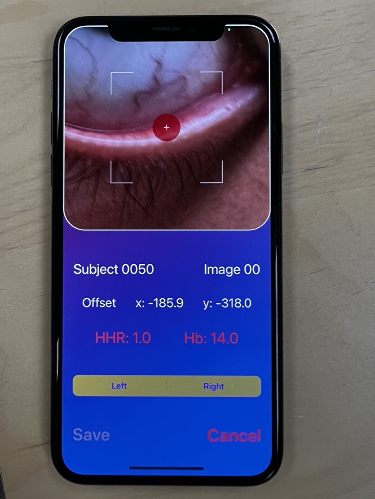 Şimdi Brown Üniversitesi'nde hem acil tıp, hem de mühendislik profesörü olarak acil durum ve afet tıbbı direktörlüğü yapan Prof. Dr. Selim Suner, kansızlığı göz içinden sadece 2 saniye içinde ölçebilen bir uygulama geliştirdi. Suner'in yapay zeka destekli uygulaması eMoglobin ile kansızlık düzeyi, cep telefonuyla göz içinden çekilen bir kare fotoğrafla anında ölçülebilecek. Dünyada ilk olacak uygulama, en çok da saniyelerin bile önem taşıdığı kanamalı acil hastaların teşhisinde hayat kurtaracak.<br>Dünya nüfusunun yaklaşık üçte birinde kansızlık olduğu tahmin ediliyor. Halsizlik, yorgunluk ve ciltte solgunluk belirtileriyle kendini gösteren kansızlığın tespiti içinse hastaneye gidilmesi, damardan kan alınması ve yaklaşık 2 saat süren laboratuvar sürecinin beklenmesi gerekiyor. Oysa artık, Amerika'da yaşayan bir Türk doktor ve mühendisin geliştirdiği tele tıp uygulaması ile kansızlık ölçümü tam anlamıyla "göz açıp kapayıncaya kadar" yapılabilecek. 