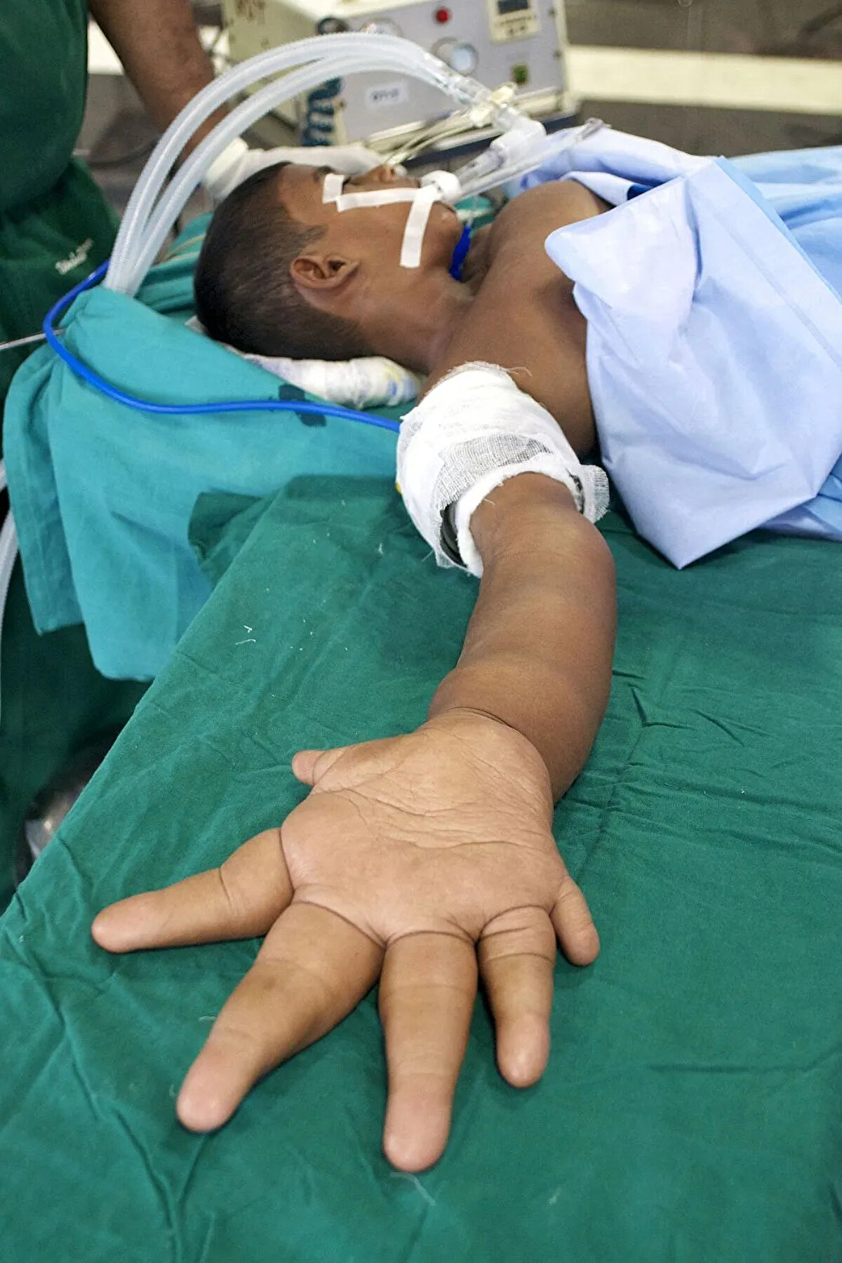 Şimdilerde 16 yaşında olan Mohammad Kaleem'in elleri yıllar sonra yeniden görüntülendi.