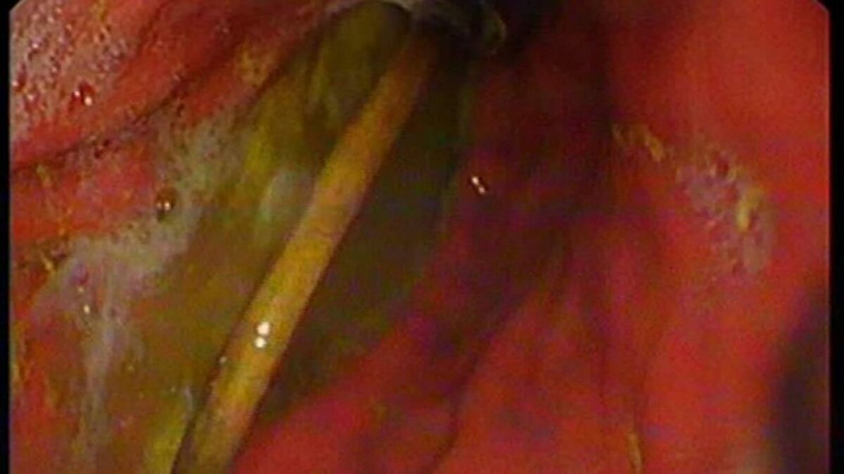 Bunun üzerine çocuk, ambulans ile Fırat Üniversitesi Hastanesi'ne sevk edildi. Üniversitenin Çocuk Gastroenteroloji Hepatoloji ve Beslenme Bilim Dalı Başkanı Prof. Dr. Yaşar Doğan ve ekibi tarafından yapılan endoskopik işlemle çocuğun midesindeki kablo ve toka başarıyla çıkarıldı. Tedavisinin ardından sağlığına kavuşan çocuk taburcu edildi.