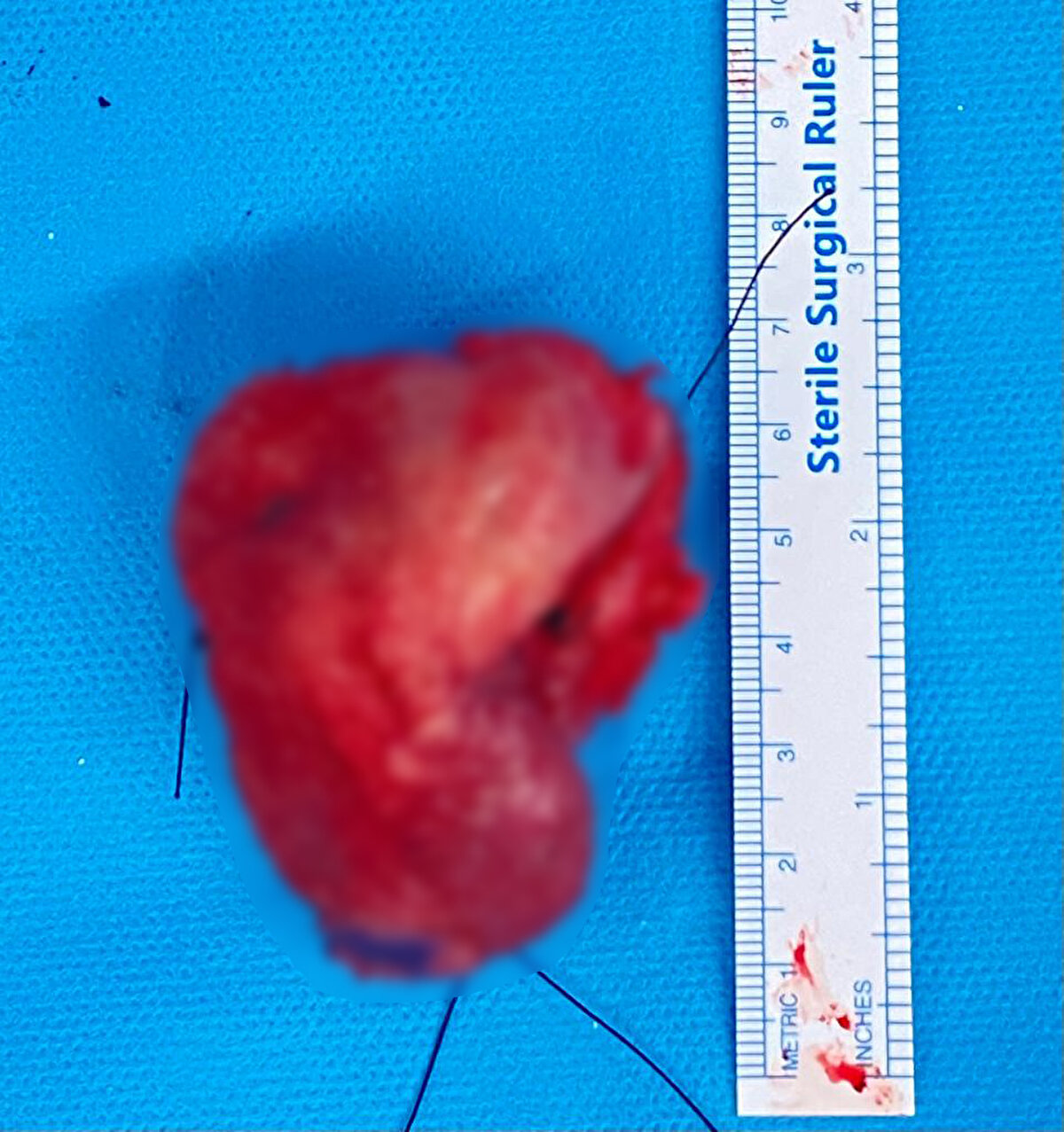 Hüseyin konuşmakta zorlandığı için hastalık sürecini anlatan annesi Hatice Eryılmaz, “Oğlumun 2 dişi çürüktü, biri çekildi diğerine iltihap olduğu için doktor önce tedavi vermiş, sonra çekelim demiş. Oğlum da ağrısı geçince dişin çekilmesi için gitmemiş. Diş zamanla kırılıp, dilini kesmiş, oğlum geçer diye önemsemedi. 1 aydan sonra yara iyileşmeyince biz de tedirgin olduk ama oğlum geçeceğini söyledi. Dildeki yara büyüdü, konuşmakta, yemede, içmede zorluk çekiyordu. Ağrılarından dolayı sürekli ağrı kesici kullanıyordu. Oğlum biraz ihmalkâr davrandı. Çok korktuk çünkü yaşı küçük, hiç aklımızda yoktu. Alkol ve sigara da kullanmazdı. Şükür ameliyattan sonra daha iyi olacağız. 10 Ocak’ta nişan yapacaktık, yarası geçmeyince doktor arayışına girdik. Bazı doktorlar bizi daha çok korkuttu. En sonunda Tayfun hocamla tanıştık, bize umut oldu. Çok şükür şu anda oğlum iyi. Çok hareketli, yerinde duramayan bir çocuktu, bir anda her şeyden kopması ona da bize de ağır geldi. Oğlum bir giyim mağazasında müdür, işine de dönecek patronları ve nişanlısı bu dönemde bizi hiç yalnız bırakmadı” dedi.<br><br>