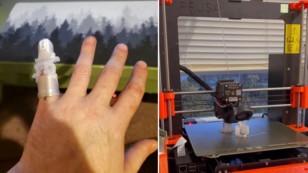 ABD'de yaşayan Adam Cutshall, 20 yıl önce alkolün etkisindeyke kullandığı elektrikli el aletiyle parmağını kesmiş, bir kısmını kaybetmişti.