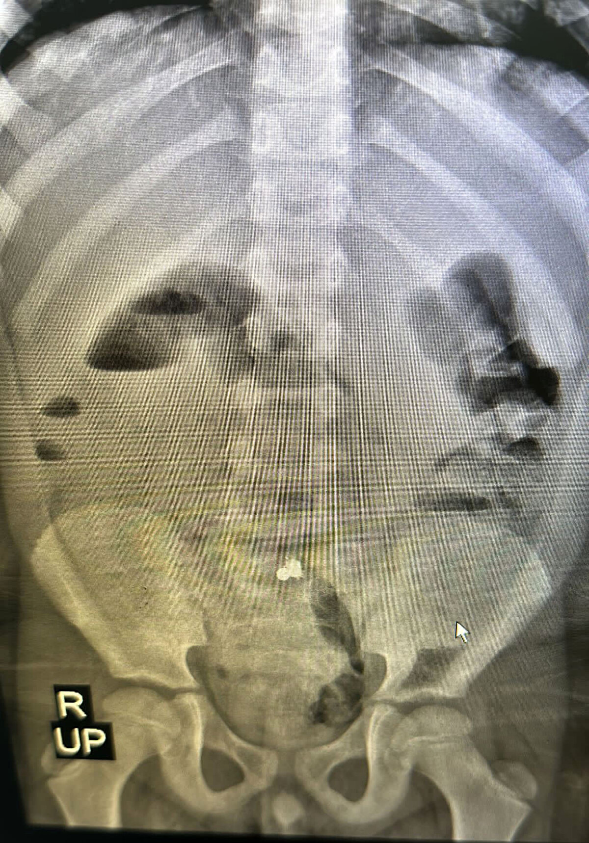 Tedavinin ardından sağlığına kavuşan çocuk, birkaç gün içinde taburcu edilecek.<br><br>Dr. Öğr. Üyesi Çakmak, gazetecilere, elektromanyetik cisimlerin bağırsaklara yapışıp delinme yapabildiğini belirterek, evlerde çocuğun yutabileceği, yemek borusuna, nefes borusuna girebilecek oyuncakların olmaması gerektiğini söyledi.