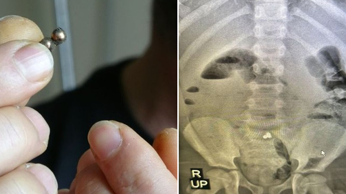 Çekilen röntgende bağırsağına yapışmış 3 parça mıknatıs tespit edilen çocuğun ameliyatına karar verildi.