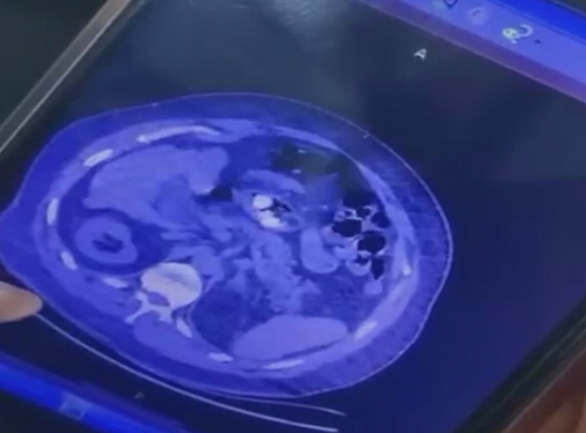 Ancak ertesi gün akşam saatlerinde Harotonian konakladığı otelde karın ağrısı şikâyeti ile fenalaştı. Rupen Harotonian, otel görevlilerinden ambulansı aramasını istedi.