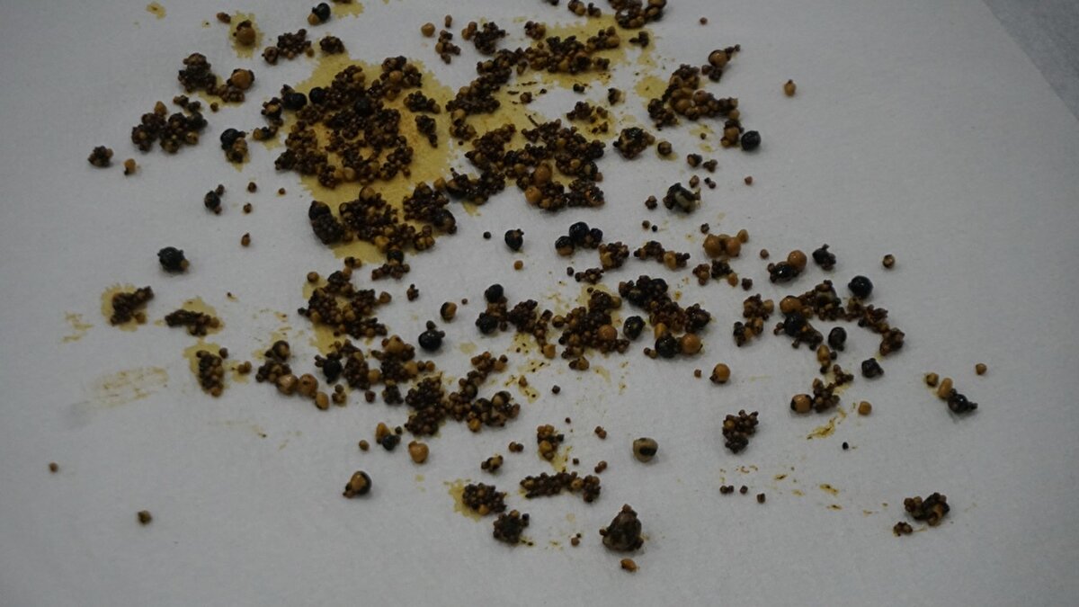 Doç. Dr. Akın Önder, yaklaşık 35 dakika süren ameliyatla, hastanın safra kesesinden 2 bin taş çıkarıldığını ifade ederek, "Hastamıza, 20 yıldır safra kesesinde taş olduğu belirtilmiş. Ameliyat da önerilmiş. Hasta biraz kilosunun fazlalığından, biraz da korkusundan hep ertelemiş. Özellikle midede hazımsızlık, şişkinlik, halsizlik ve ara ara bulantı şikayetleriyle bizlere başvurdu. Yaptığımız ultrasonda ve kan tetkiklerinde, safrasında çok sayıda taş olduğunu söyledik. Hastaya gereken durumu izah ettik. Açık değil, kapalı bir şekilde olacağını belirttik. Hasta da ikna oldu ve ameliyata aldık. Ameliyattan sonra safrayı açtığımızda biz de çok şaşırdık. Yaklaşık 2 bin taş vardı. Şu an hastanın durumu gayet iyi, hayati bulgular stabil. Allah'tan bir mani olmazsa yarın sabah taburcu edeceğiz" diye konuştu.