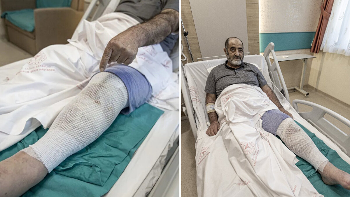 Ağrısını dindirmek için bacaklarına sardığı ısırgan otu Nakip Uzun’u hastanelik etti.<br><br>5 çocuk babası 73 yaşındaki Uzun, bir süredir ağrıyan diz ve bacaklarını doktora muayene ettirmek yerine, çevresinden aldığı tavsiyeler ile “ısırgan otu” ile sardı.<br><br>Kaynattığı otları bacaklarına bağlayıp yaklaşık bir gün bekleten Uzun’un ağrıları daha da arttı.<br><br>Uzun, bunun üzerine sargıyı açınca iki bacağında da şişlik ve derin yanıklar oluştuğunu gördü.