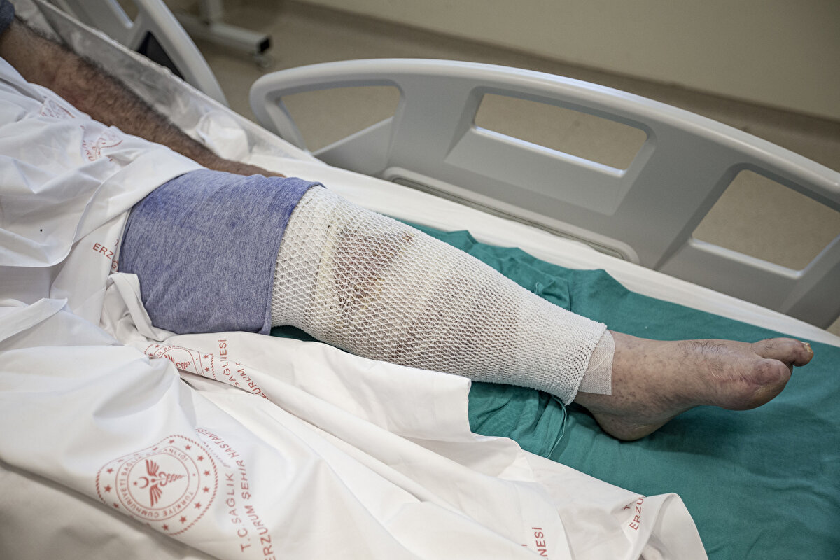 Otları kaldırdığında bacaklarındaki yaraları görünce şaşıran ve ağrılarının çoğalmasıyla şehir hastanesine başvuran Uzun, romatizma ve kireçleme şikayetleri olduğunu belirterek şunları kaydetti:<br><br>“Doktora gitmeden bacaklarımın ağrılarını hallederim demiştim ama halledemedik ve bacaklarım bu hale geldi. Hiç kimse böyle iş yapmasın, yani ot bağlayıp da ‘ayaklarını iyileştiririm’ demesin. Allah’a şükür devletimiz, doktorumuz var. Yaptığım işten çok pişmanım. Bundan sonra koca karı ilaçlarından önce doktora gitmeyi tavsiye ediyorum. Vatandaşlar her zaman hallerini hekime arz etsin, onlar da zaten gerekeni yapıyor.”