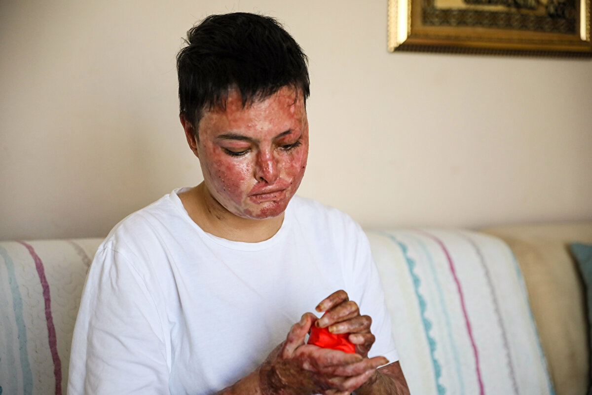 'ETRAFTAKİLER, YANAN KIYAFETLERİMİ SÖNDÜRDÜ'<br>Süreci atlatmasının çok zor olduğunu söyleyen Beyzanur Hatmorioğlu, "Yanımdaki arkadaşım aracın benzin şamandırasını söktü. Ona yardım ediyordum. Arkadaşım 'Arabanın üzerinde deneyelim' dedi. Şamandırayı yerine taktık ve elektrik verince araba alev aldı. Arabanın içerisindeydim ve bir süre çıkamadım. Etraftakiler, yanan kıyafetlerimi söndürdü. 2 ay kadar yoğun bakımda kaldım. Bu süreçte 15 ameliyat oldum. Normalde doktorlar, 4 ay yoğun bakımda, 4 ay da serviste kalacağımı söyledi ama daha kısa sürede iyileştim" dedi.